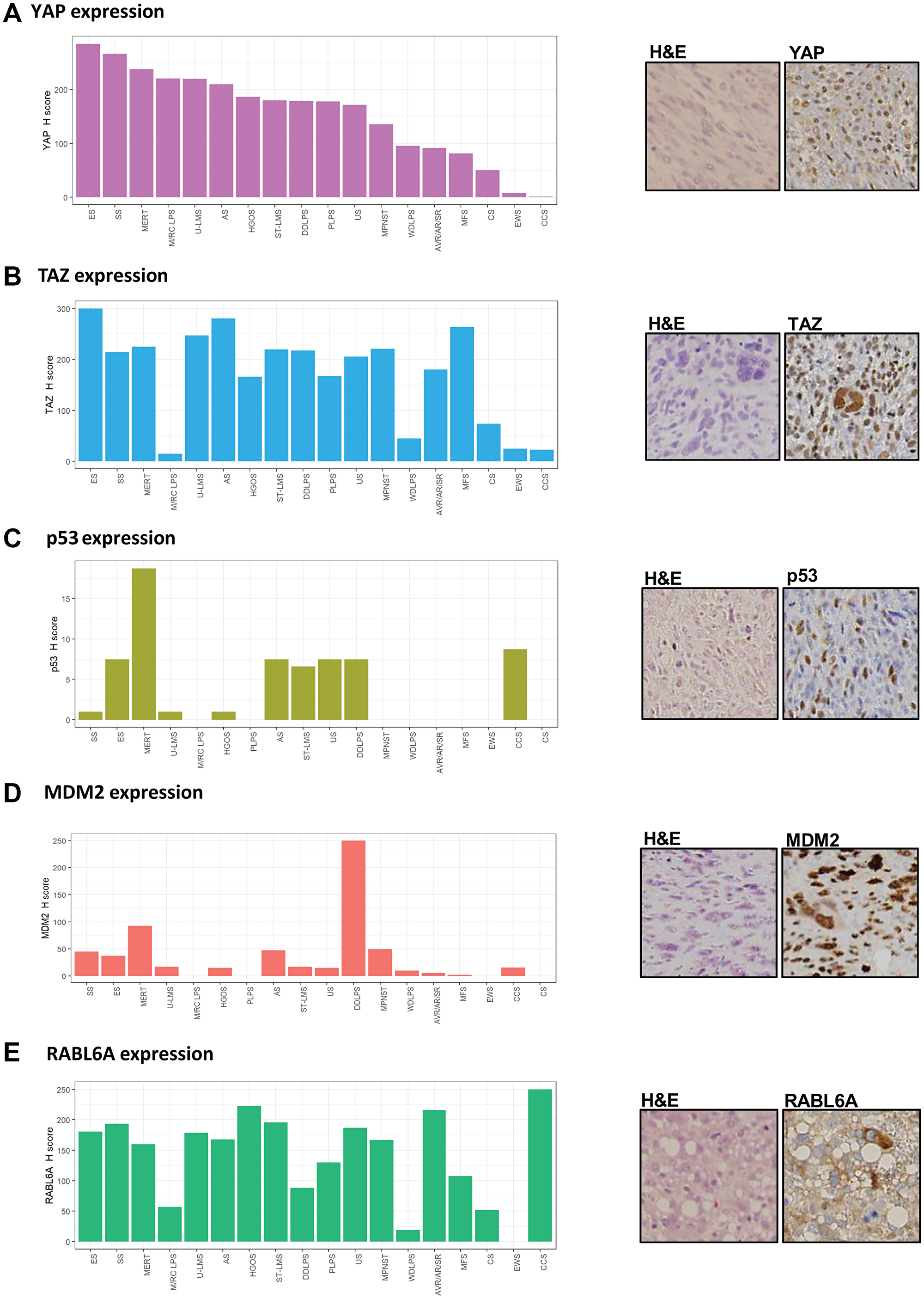 YAP, TAZ, p53, MDM2 and RABL6A are widely expressed in various sarcomas
