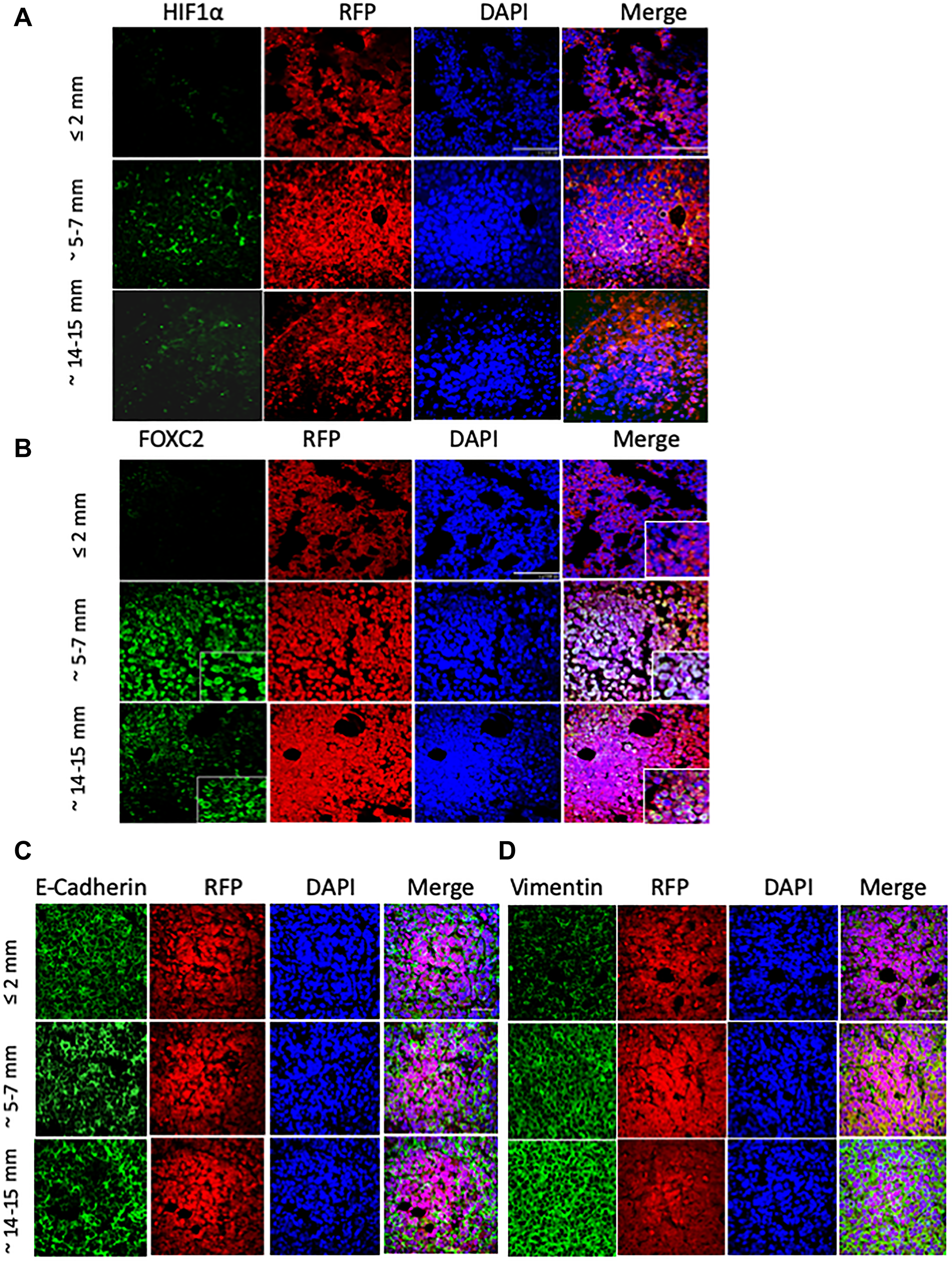 MCF-7 tumor outgrowth is accompanied by increased expression of markers of EMT and hypoxia