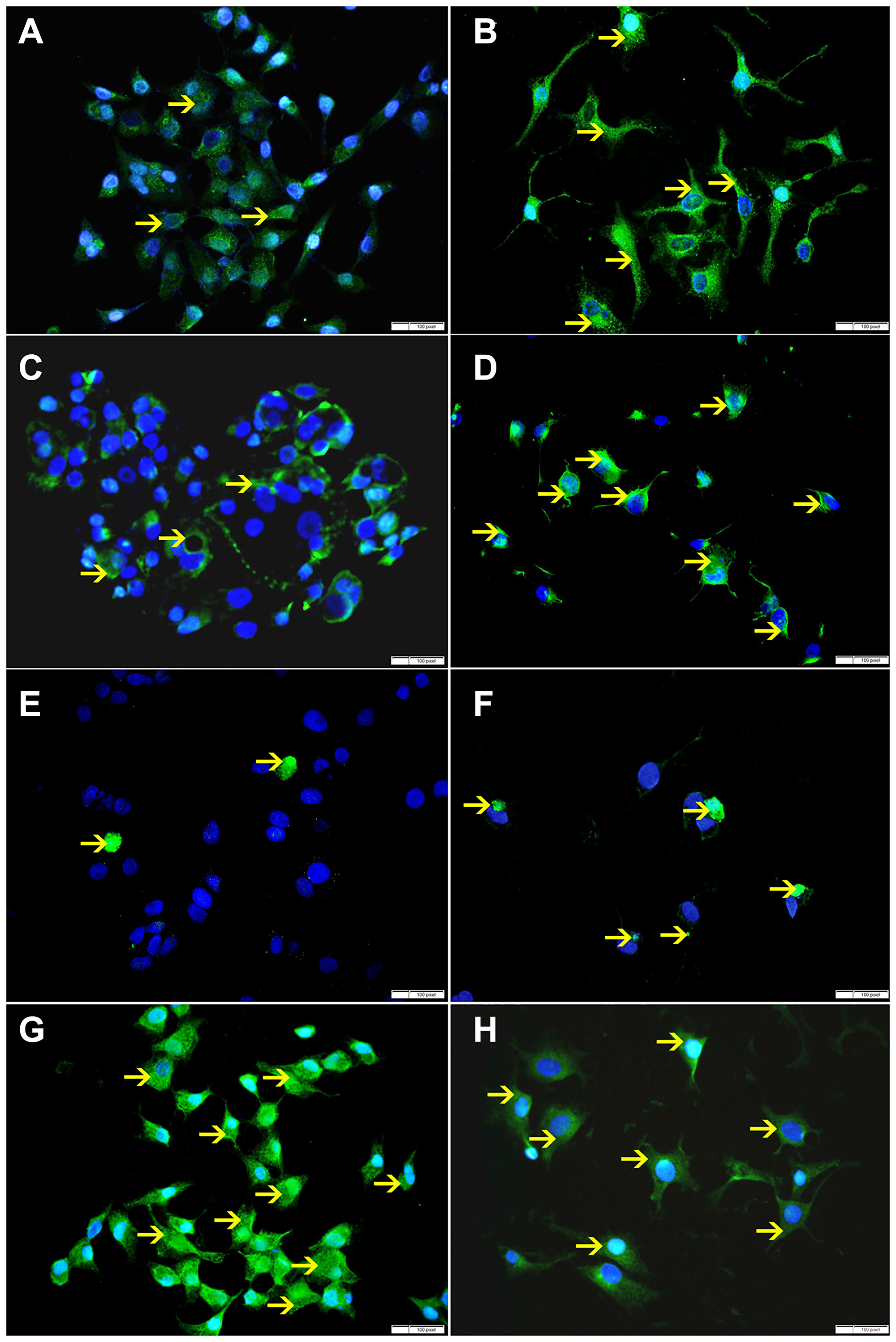 (A) Showing low cytoplasmic expression of Bax by non-treated HeLa cells (arrow). (B) Showing higher cytoplasmic expression of Bax by SO 60mmol treated HeLa cells (arrow). (C) Showing low cytoplasmic expression of VDAC by non-treated HeLa cells (arrow). (D) Showing higher cytoplasmic expression of VDAC by SO 60 mmol treated HeLa cells (arrow). (E) Showing few apoptotic bodies expressing cleaved caspase-3 in non-treated HeLa cells (arrow). (F) Showing higher number of apoptotic bodies expressing cleaved caspase-3 in SO 60mmol treated HeLa cells (arrow). (G) Showing high cytoplasmic expression of Bcl-xL by non-treated HeLa cells (arrow). (H) Showing lower cytoplasmic expression of Bcl-xL by SO 60 mmol treated HeLa cells (arrow).
