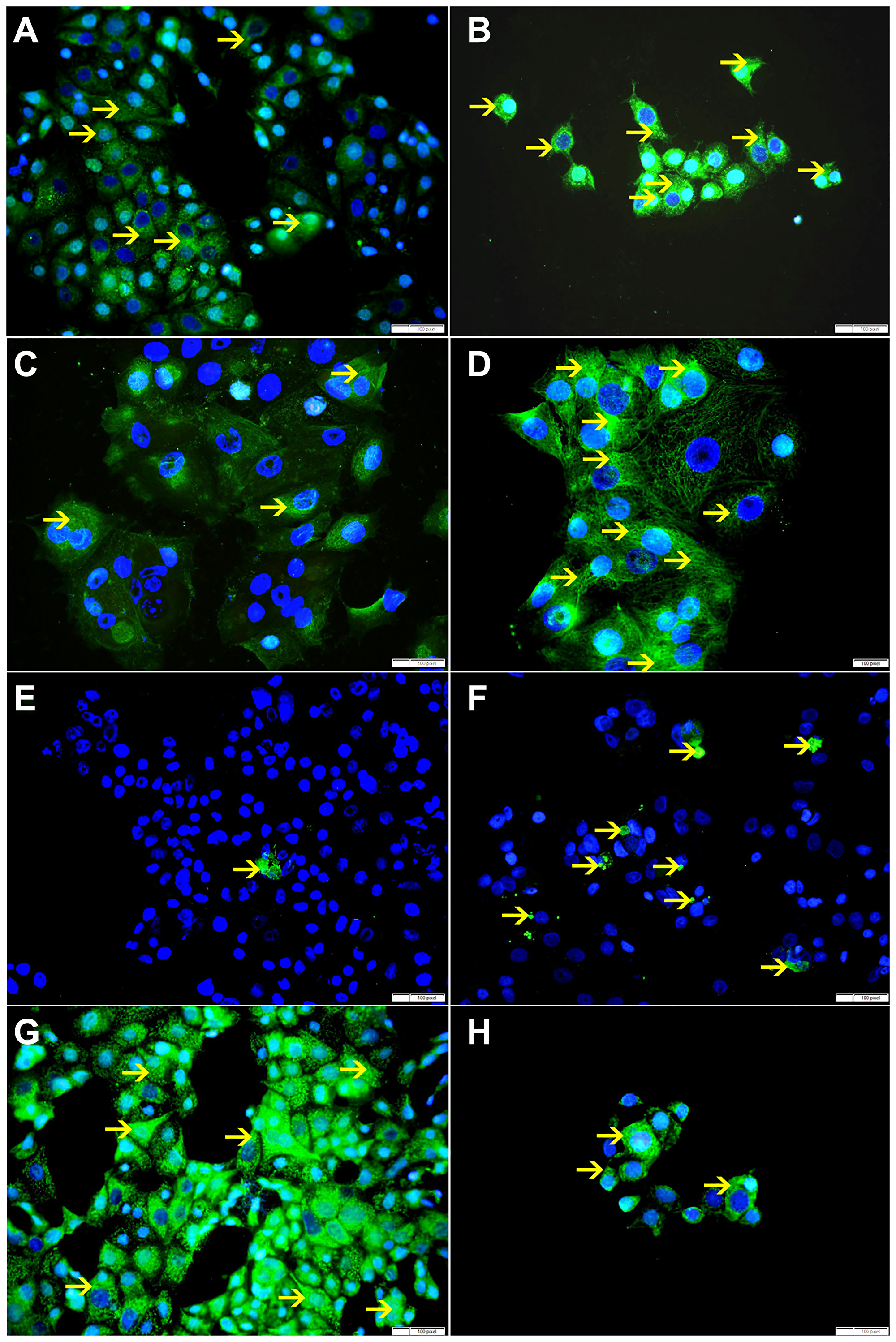 (A) Showing cytoplasmic expression of Bax by non-treated MCF-7 cells (arrow). (B) Showing higher cytoplasmic expression of Bax by SO 60 mmol treated MCF-7 cells (arrow). (C) Showing low cytoplasmic expression of VDAC by non-treated MCF-7 cells (arrow). (D) Showing higher cytoplasmic expression of VDAC by SO 60 mmol treated MCF-7 cells (arrow). (E) Showing few apoptotic bodies expressing cleaved caspase-3 in non-treated MCF-7 cells (arrow). (F) Showing higher number of apoptotic bodies expressing cleaved caspase-3 in SO 60mmol treated MCF-7 cells (arrow). (G) Showing high cytoplasmic expression of Bcl-xL by non-treated MCF-7 cells (arrow). (H) Showing lower cytoplasmic expression of Bcl-xL by SO 60 mmol treated MCF-7 cells (arrow).