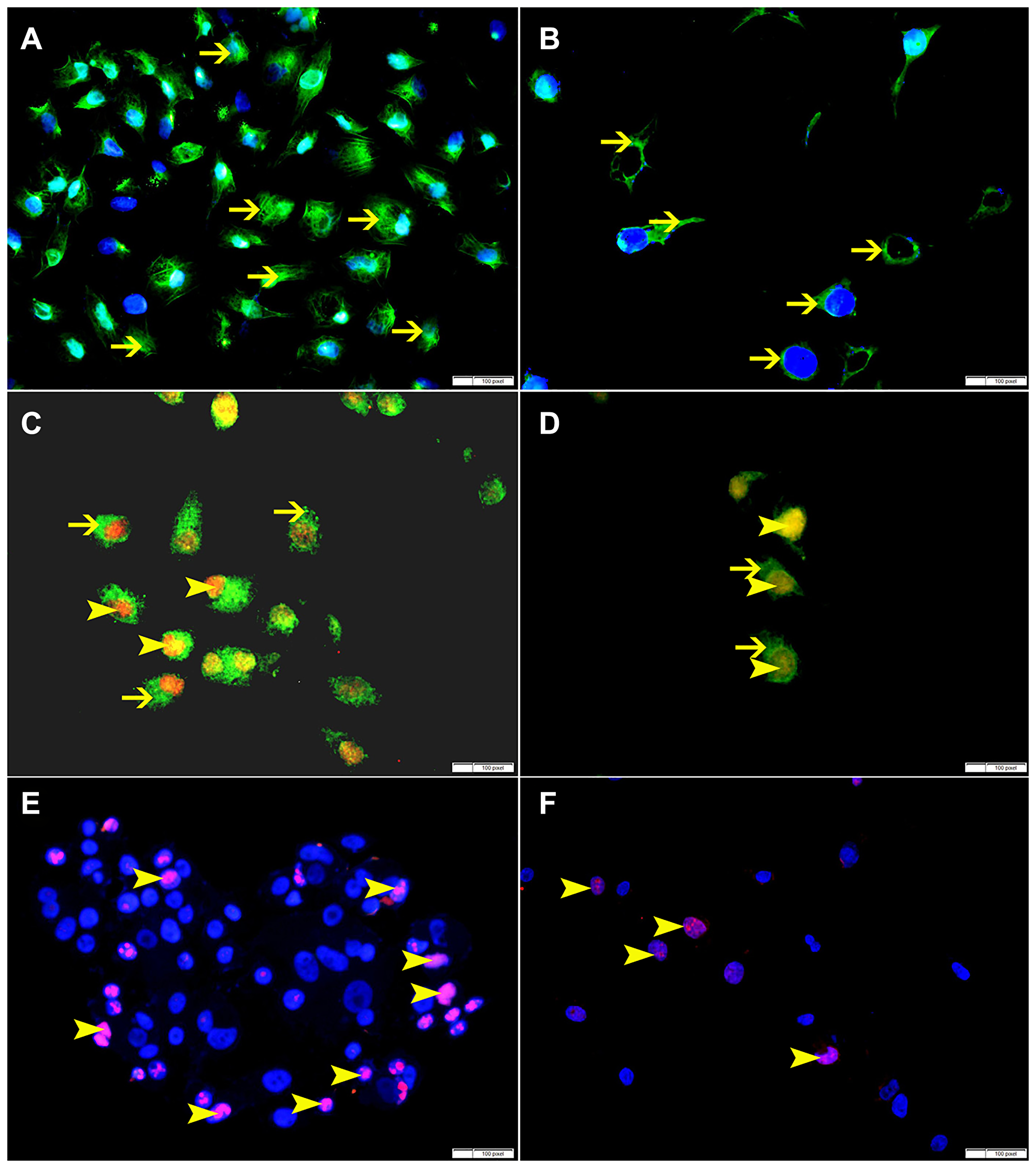 (A) Showing higher cytoplasmic expression of p-NFKB by non-treated HeLa cells (arrow). (B) Showing lower cytoplasmic expression of p-NFKB by SO 60 mmol treated HeLa cells (arrow). (C) Showing higher cytoplasmic expression of VEGF (thin arrow) and nuclear expression of BMI-1 (arrowhead) by non-treated HeLa cells. (D) Showing lower cytoplasmic expression of VEGF (thin arrow) and nuclear expression of BMI-1 (arrowhead) by SO 60 mmol treated HeLa cells. (E) Showing higher number of cells expressing ki-67 in non-treated HeLa cells (arrow). (F) Showing lower number of cells expressing ki-67 in SO 60 mmol treated HeLa cells (arrow).