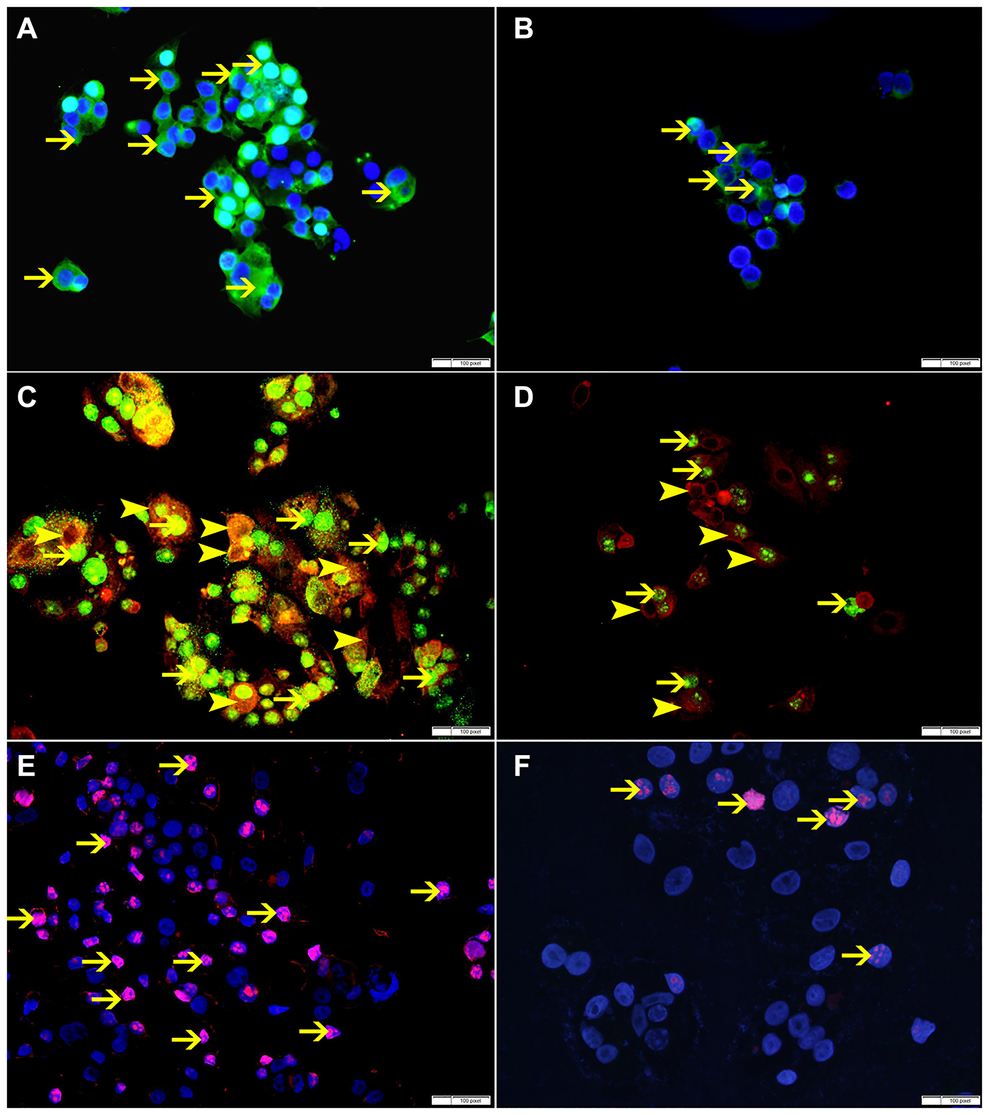 (A) Showing high cytoplasmic expression of p-NFKB by non-treated MCF-7 cells (arrow). (B) Showing lower cytoplasmic expression of p-NFKB by SO 60 mmol treated MCF-7 cells (arrow). (C) Showing higher cytoplasmic expression of VEGF (arrowhead) and nuclear expression of BMI-1 (thin arrow) by non-treated MCF-7 cells. (D) Showing lower cytoplasmic expression of VEGF (arrowhead) and nuclear expression of BMI-1 (thin arrow) by SO 60 mmol treated MCF-7 cells. (E) Showing higher number of cells expressing ki-67 in non-treated MCF-7 cells (arrow). (F) Showing lower number of cells expressing ki-67 in SO 60 mmol treated MCF-7 cells (arrow).