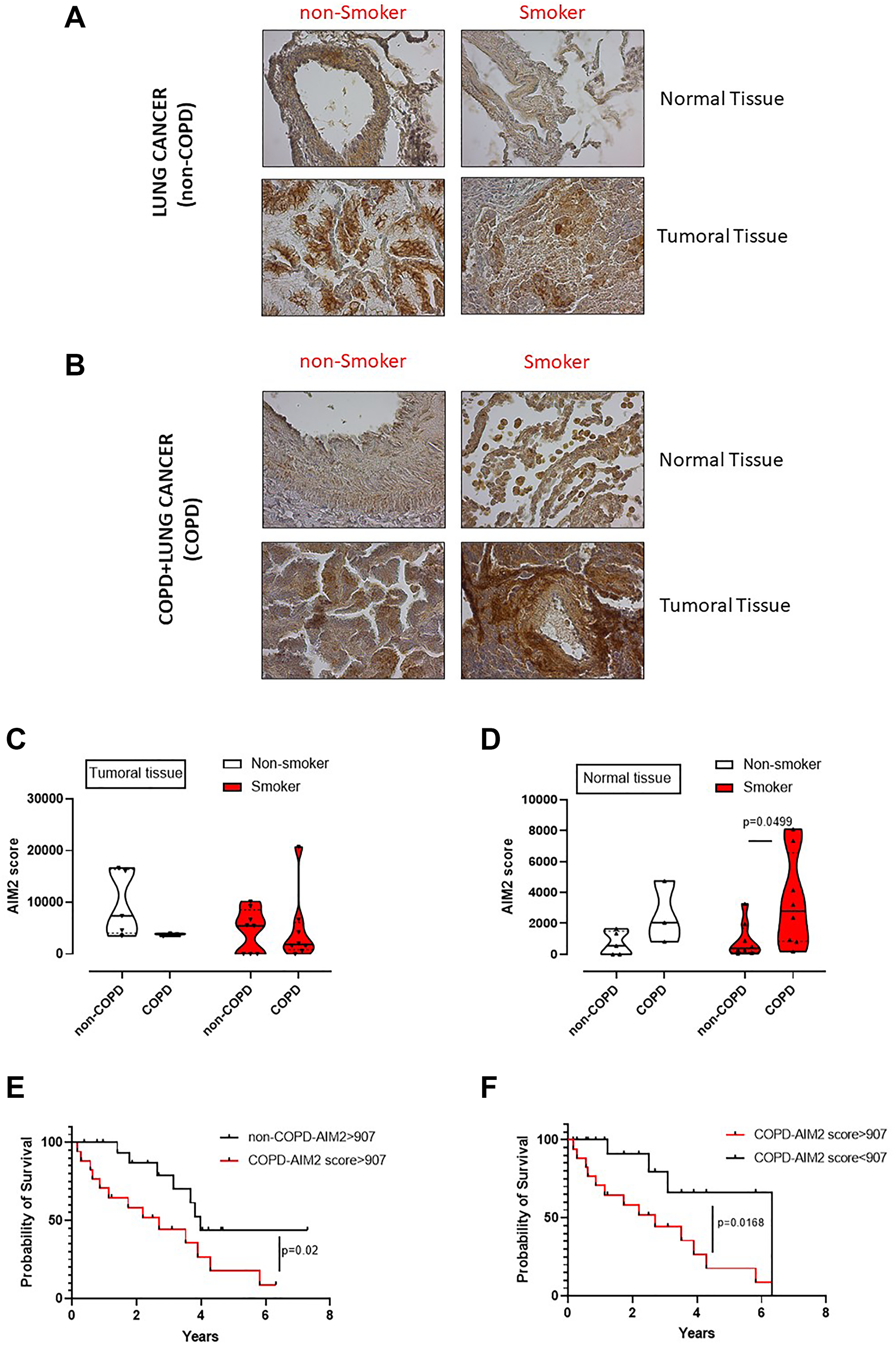 Poor survival rate of adenocarcinoma lung cancer patients according to the levels of AIM2 and smoking/COPD status
