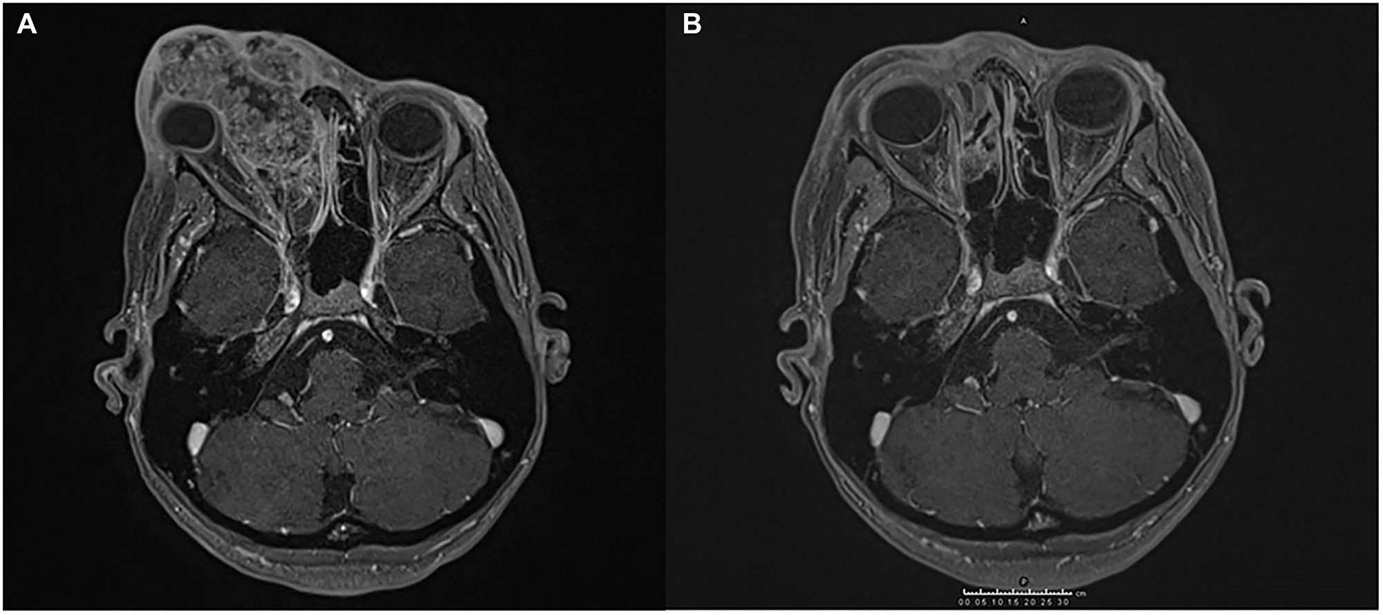 Magnetic resonance imaging (MRI) showing the response of SCC to the treatment administered