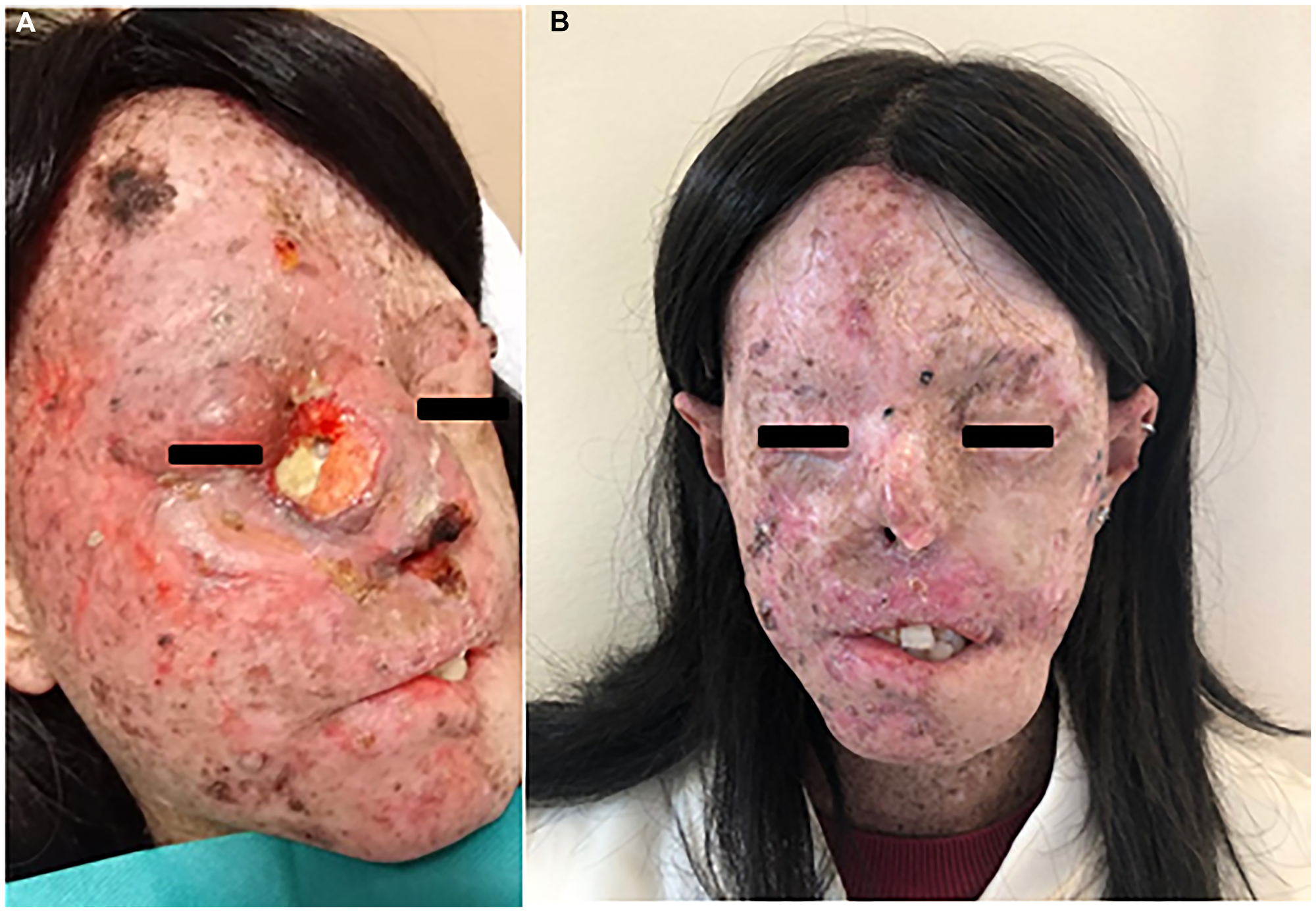 (A) SCC of the right eyelid extending to the nasal pyramid in a XP-patient before starting hadrontherapy. The patient after five infusions of Cemiplimab (B).