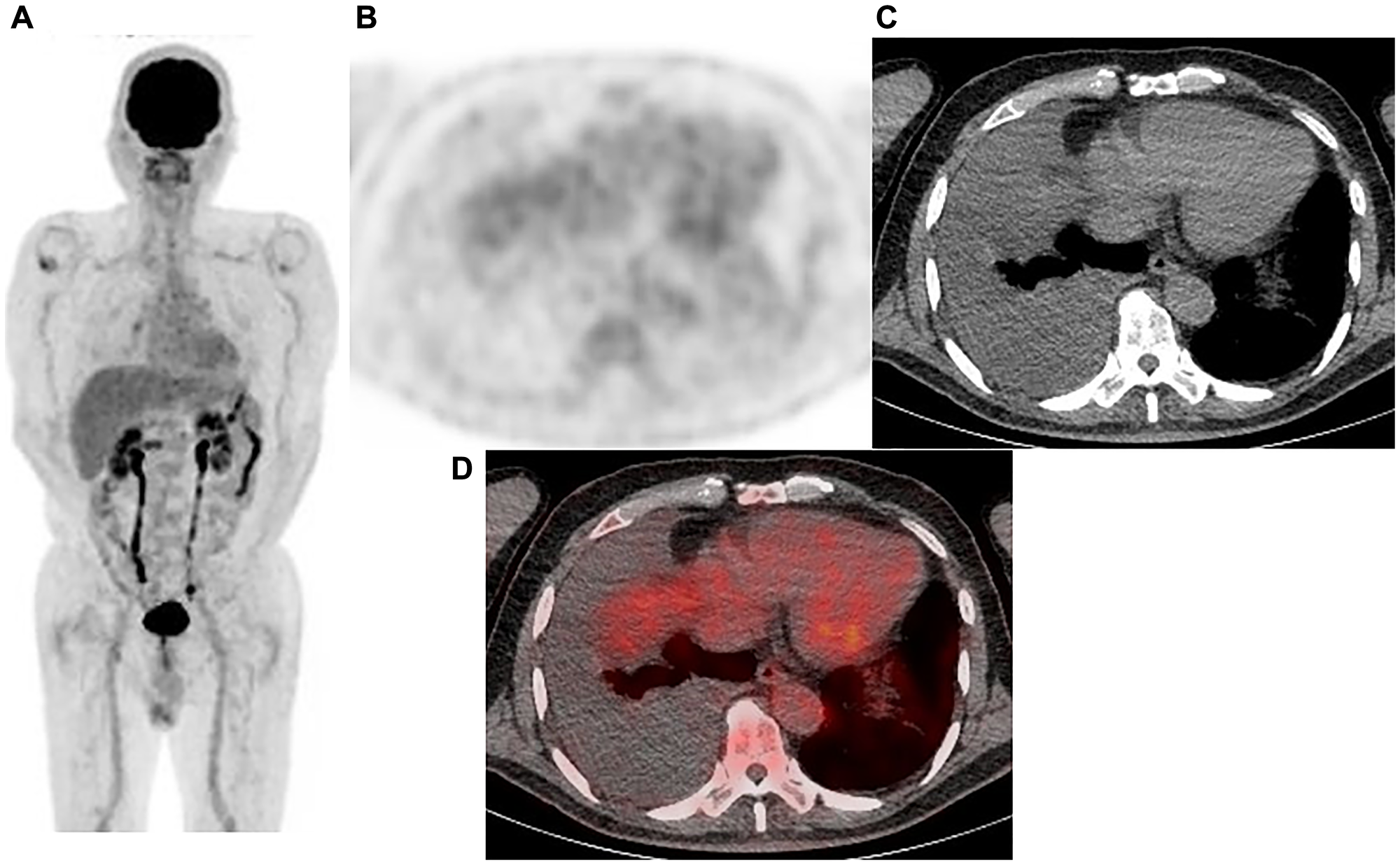 Representative case: 77-year-old male with right malignant pleural mesothelioma (epithelial type)