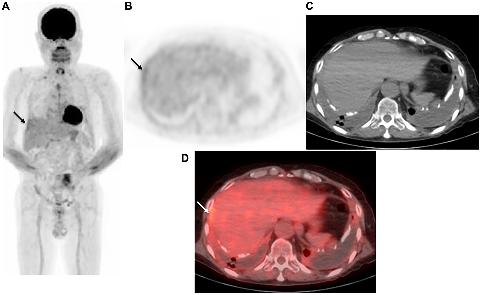 Representative case: 72-year-old male with right malignant pleural mesothelioma (epithelial type)