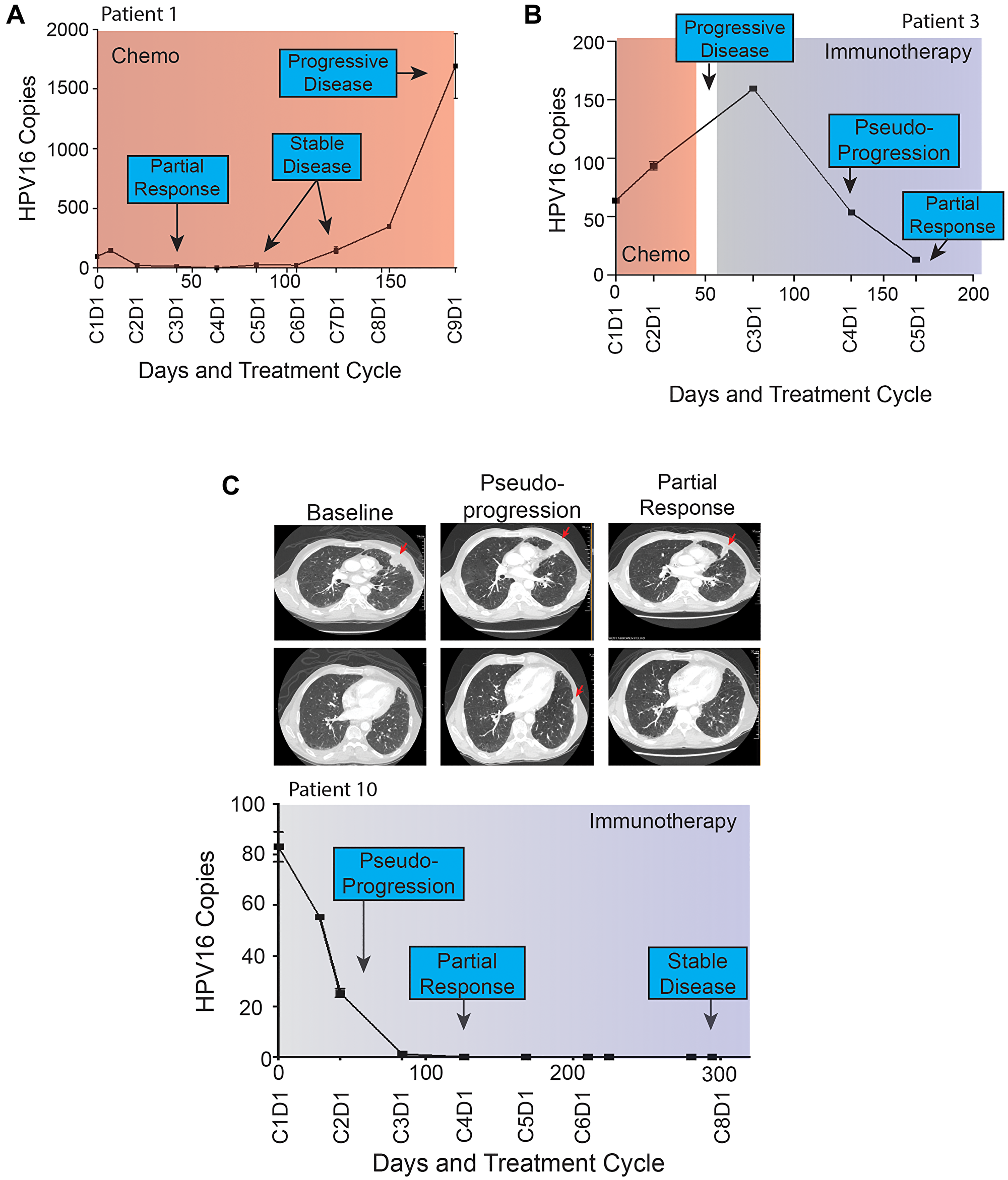(A–C) Patient HPV16 ctDNA Levels and Treatment Histories. Plasma HPV16 ctDNA levels (copies per 1 μL) measured over time in patients with p16+ R/M HPV+ OPSCC (A–C). On the X-axis is days since study enrollment as well as cycle and day (CxDx) of treatment cycle. Colored boxes represent treatment courses (chemo = chemotherapy, immune = immunotherapy). Radiographic response are noted in each graph. Panel (A) highlights HPV16 ctDNA identifying progression more than 100 days prior to radiographic imaging. (B and C) highlight patients with radiographic pseudoprogression while treated with immunotherapy. Select serial CT images are shown for patient 10 at baseline, identification of pseudoprogression, and confirmatory imaging demonstrating partial response. A left pleural based soft tissue metastasis (top row) was initially noted to increase in size abutting the mediastinum, prior to decreasing in size dramatically. Similarly, a small sub-centimeter pleural based nodule (bottom row) initially grew to 1.1 cm prior to resolving completely on confirmatory imaging.