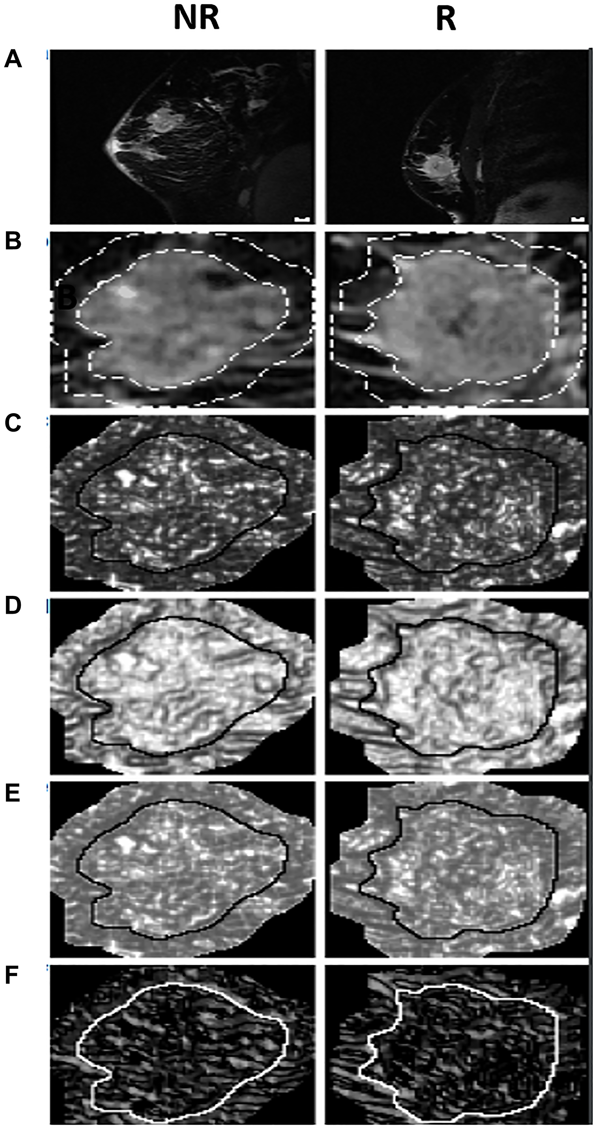 The MRI, quantized tumor ROI, and texture feature images for a typical NR and R