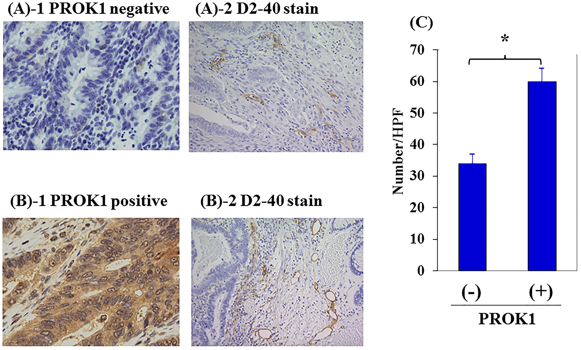 Lymph vessels in human primary colorectal cancer by immunohistochemical staining with anti-D2-40 mAb