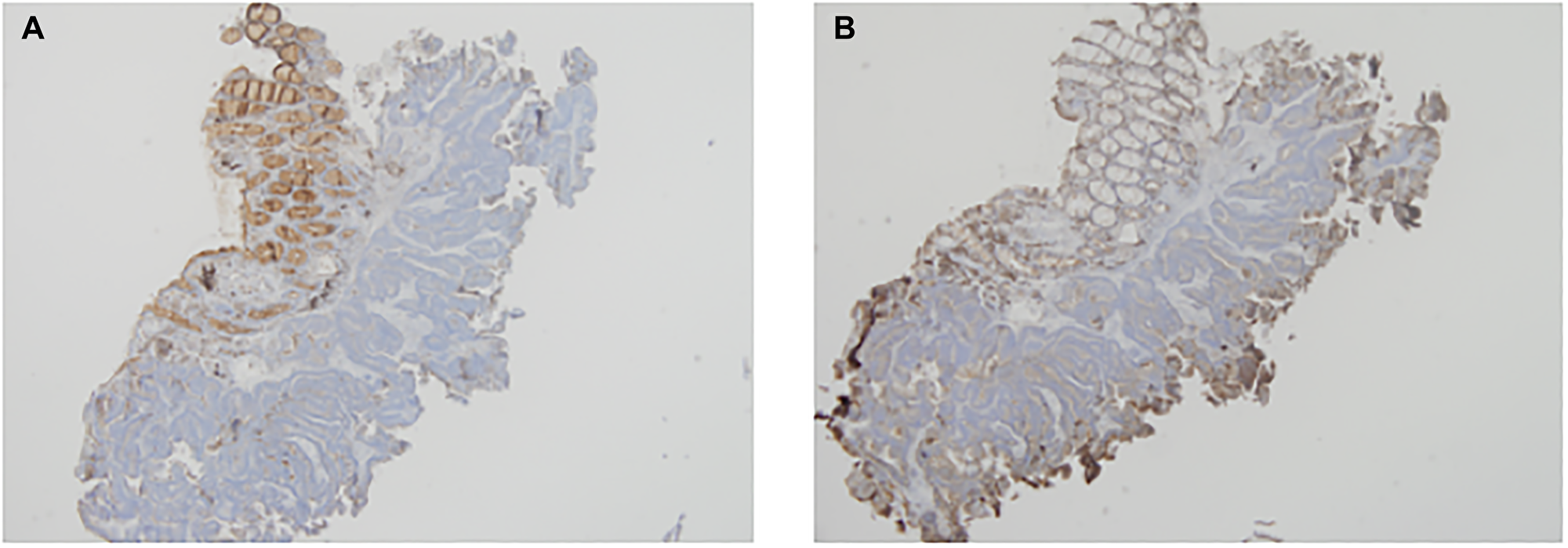 The expression of CD63 and CD9 using IHC in the pre-NCCR biopsy is shown in (A) and (B) respectively.