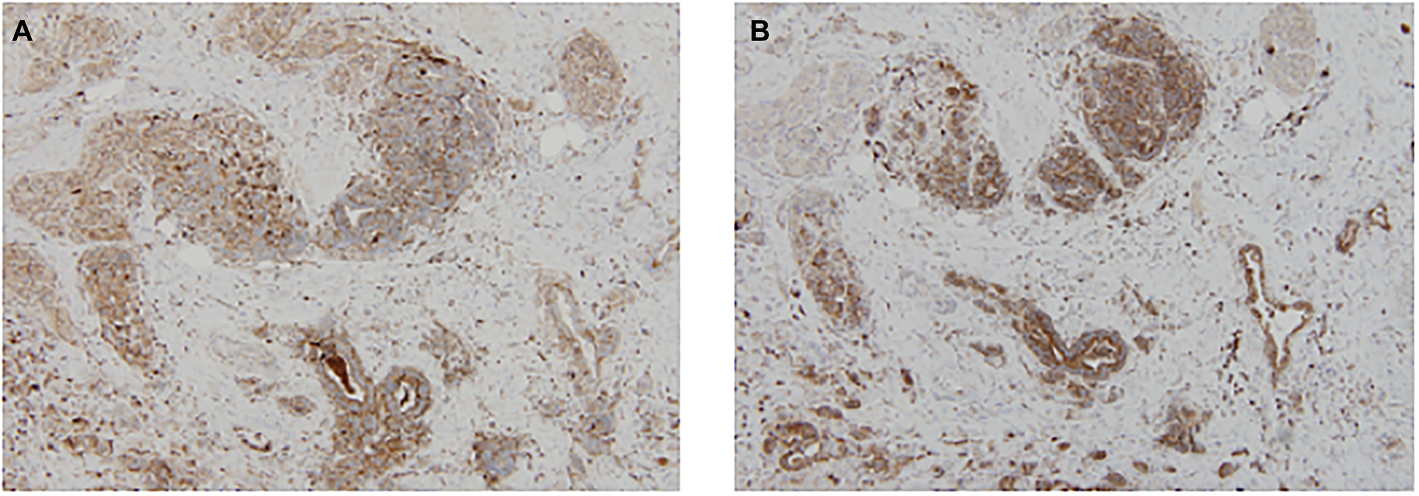 The expression of CD63 and CD9 using IHC in the post-NCCR resected rectum is shown in (A) and (B) respectively.