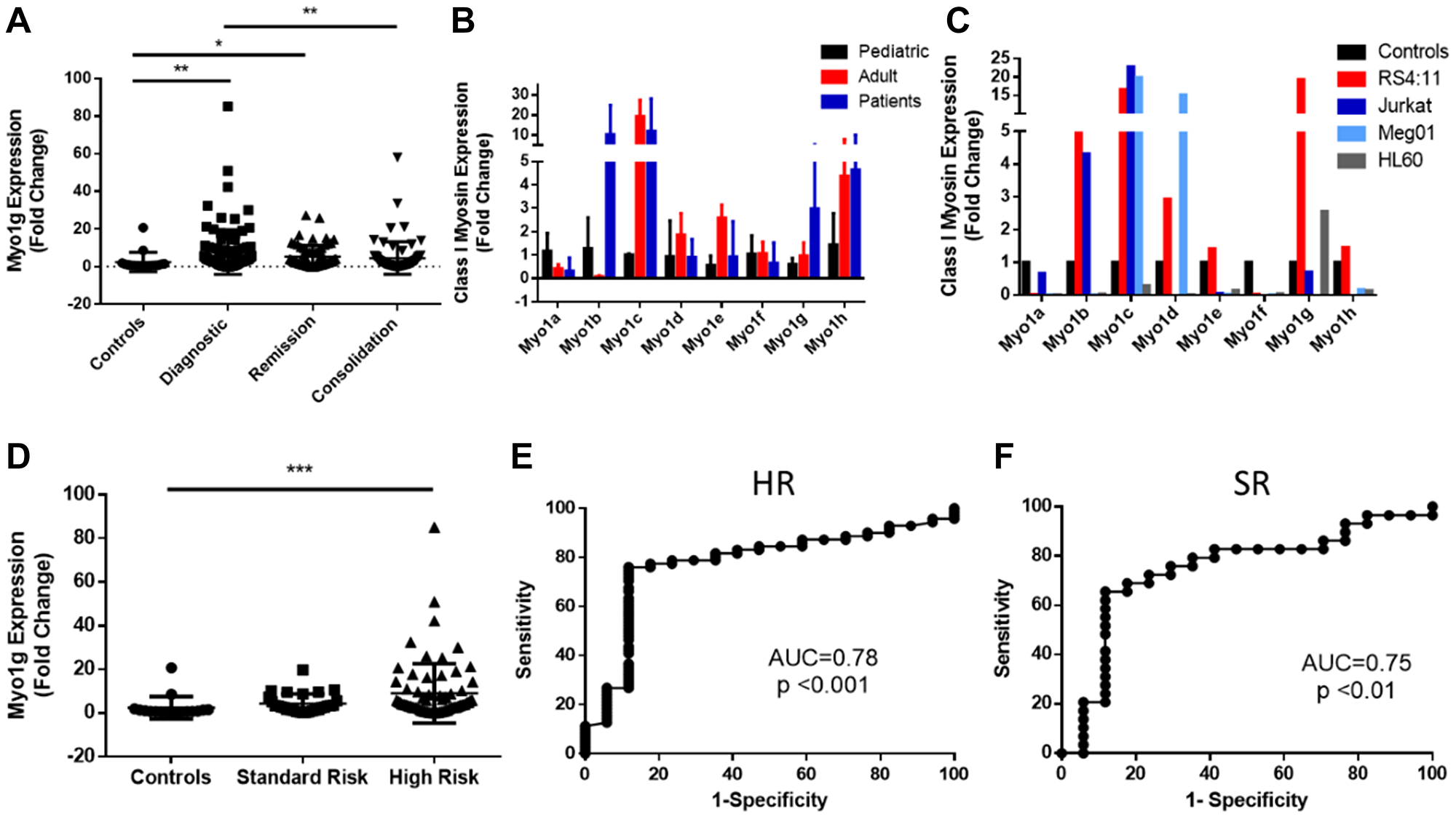 Myosin 1g is over expressed in acute lymphoblastic leukemia