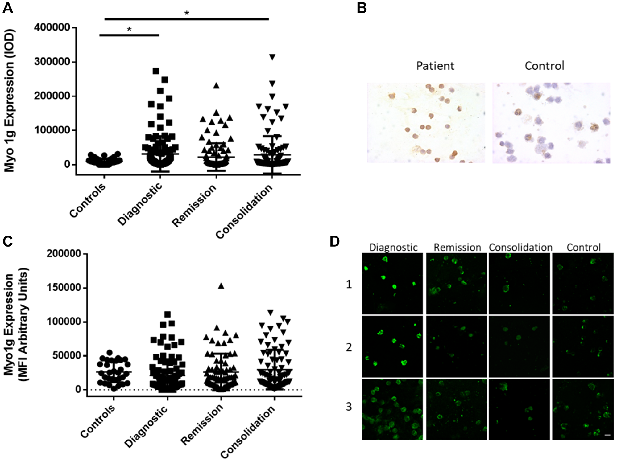 Myo1g over expression is conserved at protein level in acute lymphoblastic leukemia