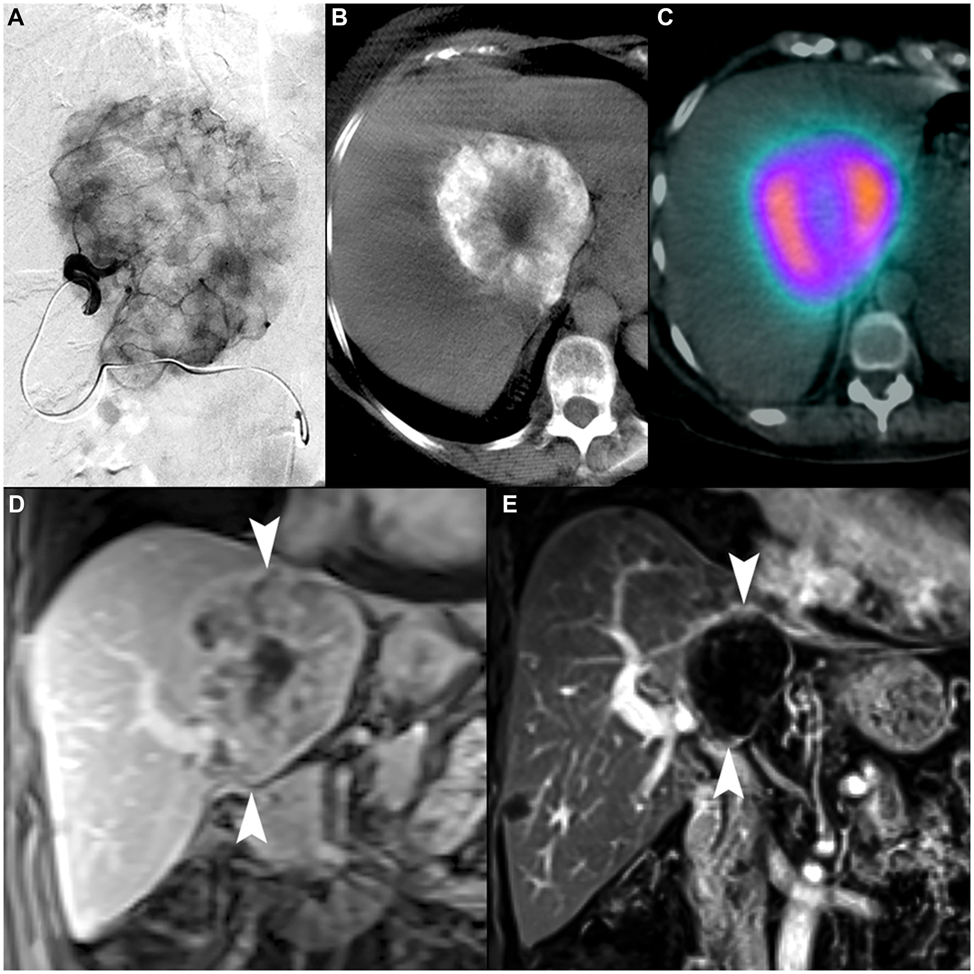 70-year-old female with intrahepatic cholangiocarcinoma