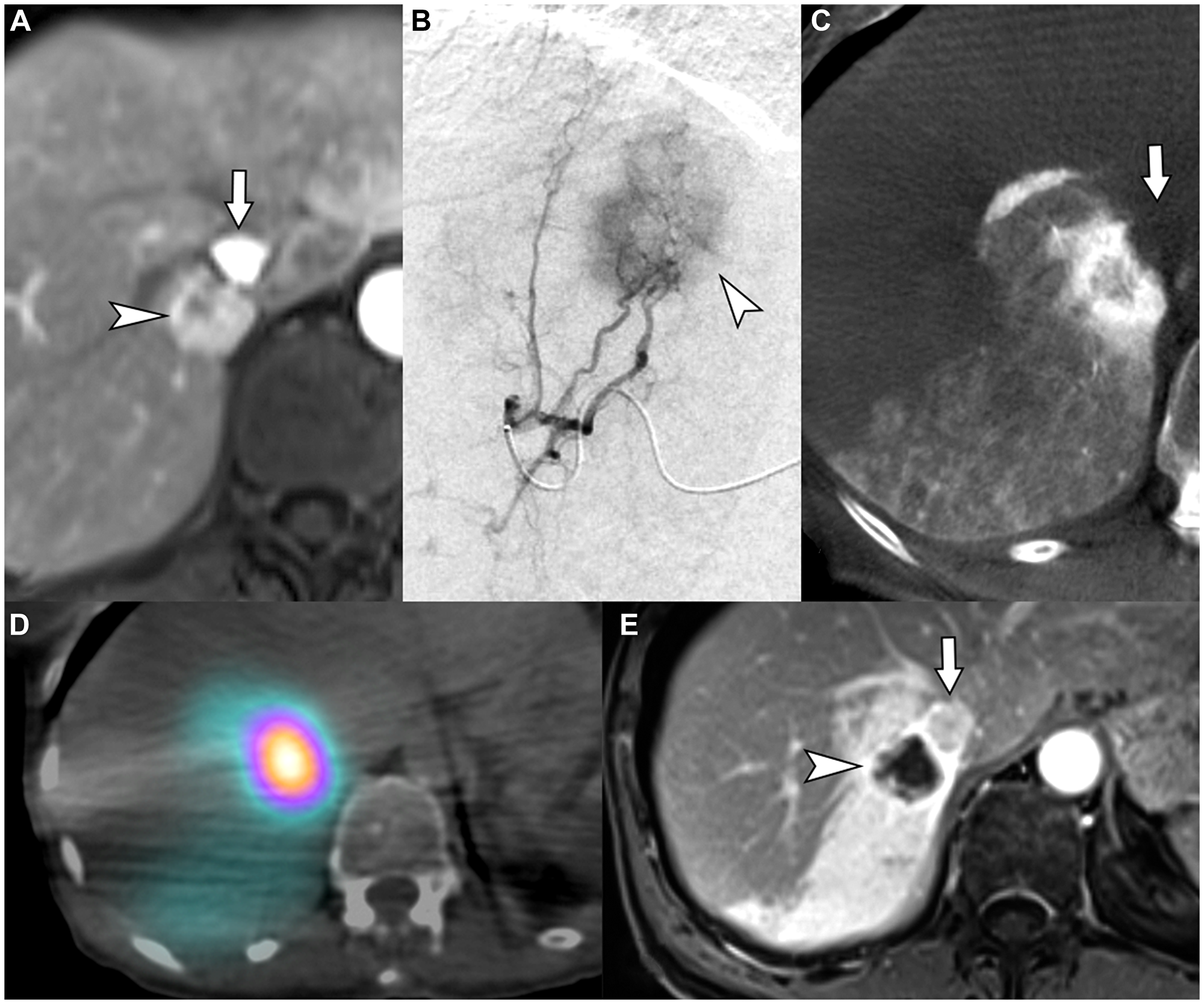 62-year-old female with intrahepatic cholangiocarcinoma in need for liver therapy as a bridge to hepatic resection while being treated for an unrelated second primary adenocarcinoma of lung