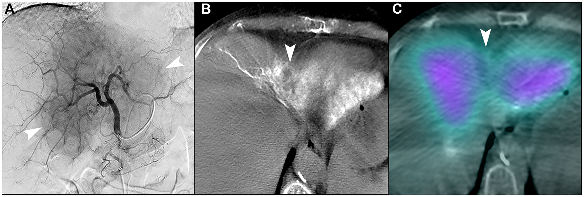 Unfavorable macrovascular and microvascular arterial conduit in two patients with intrahepatic cholangiocarcinoma