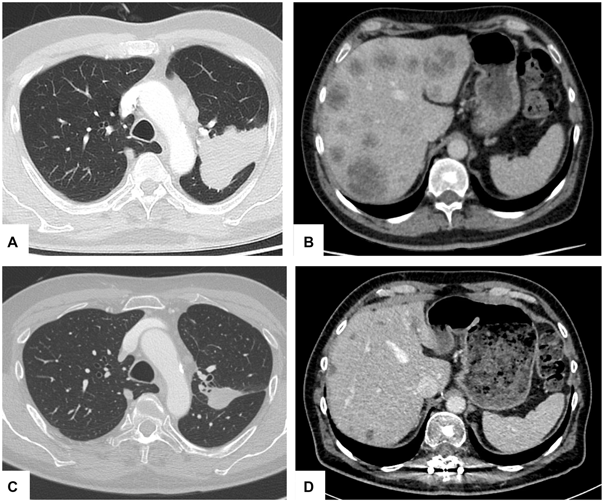 Hepatic and pulmonary tumor response during therapy