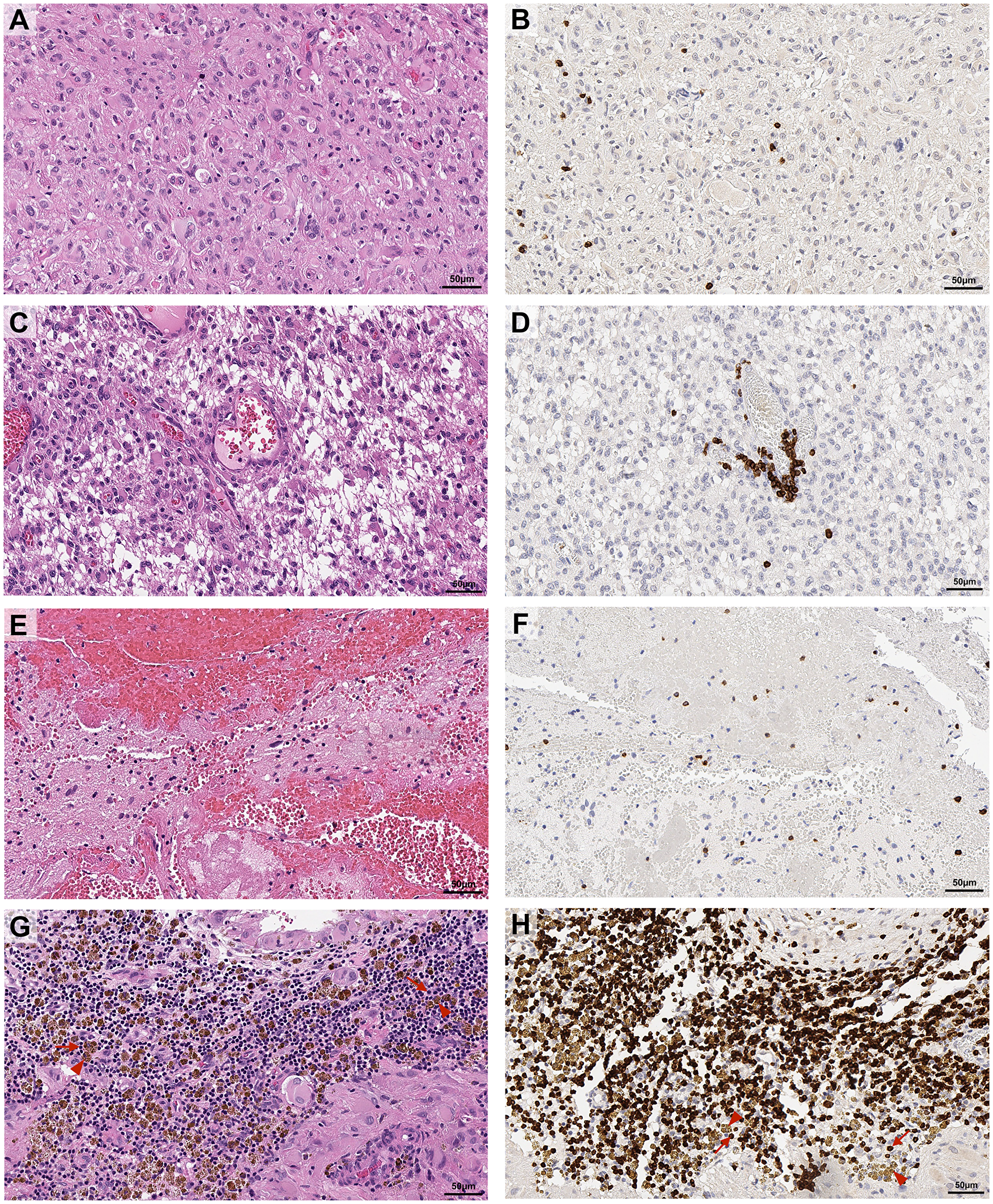 Representative images of topographical localisation of T cells in glioblastoma tumours