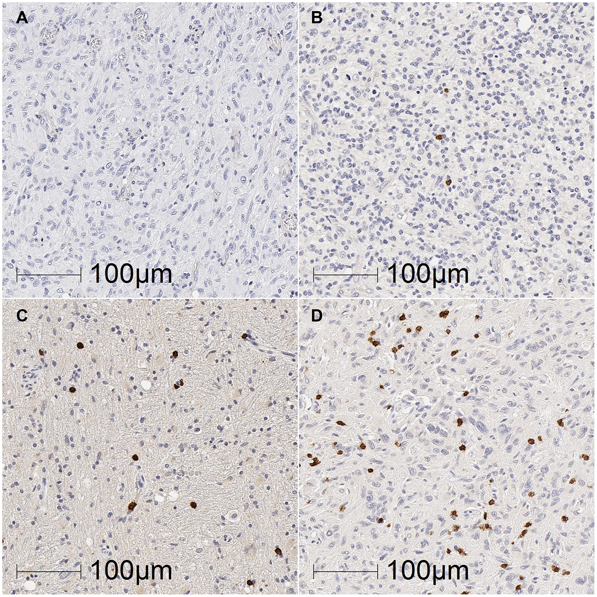 Representative images of TIL density in glioblastoma tumours