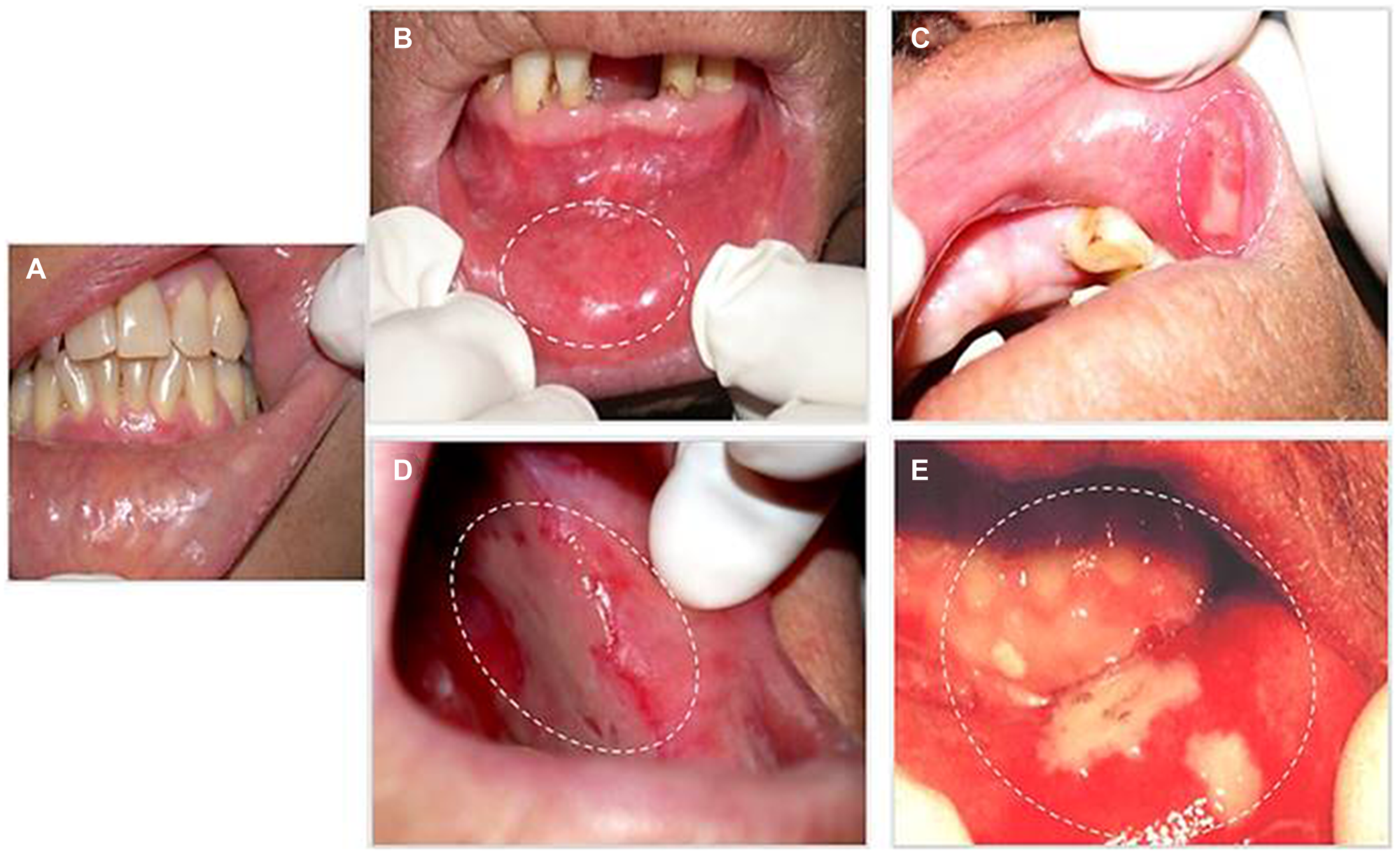 Evolution of human OM during chemoradiotherapy