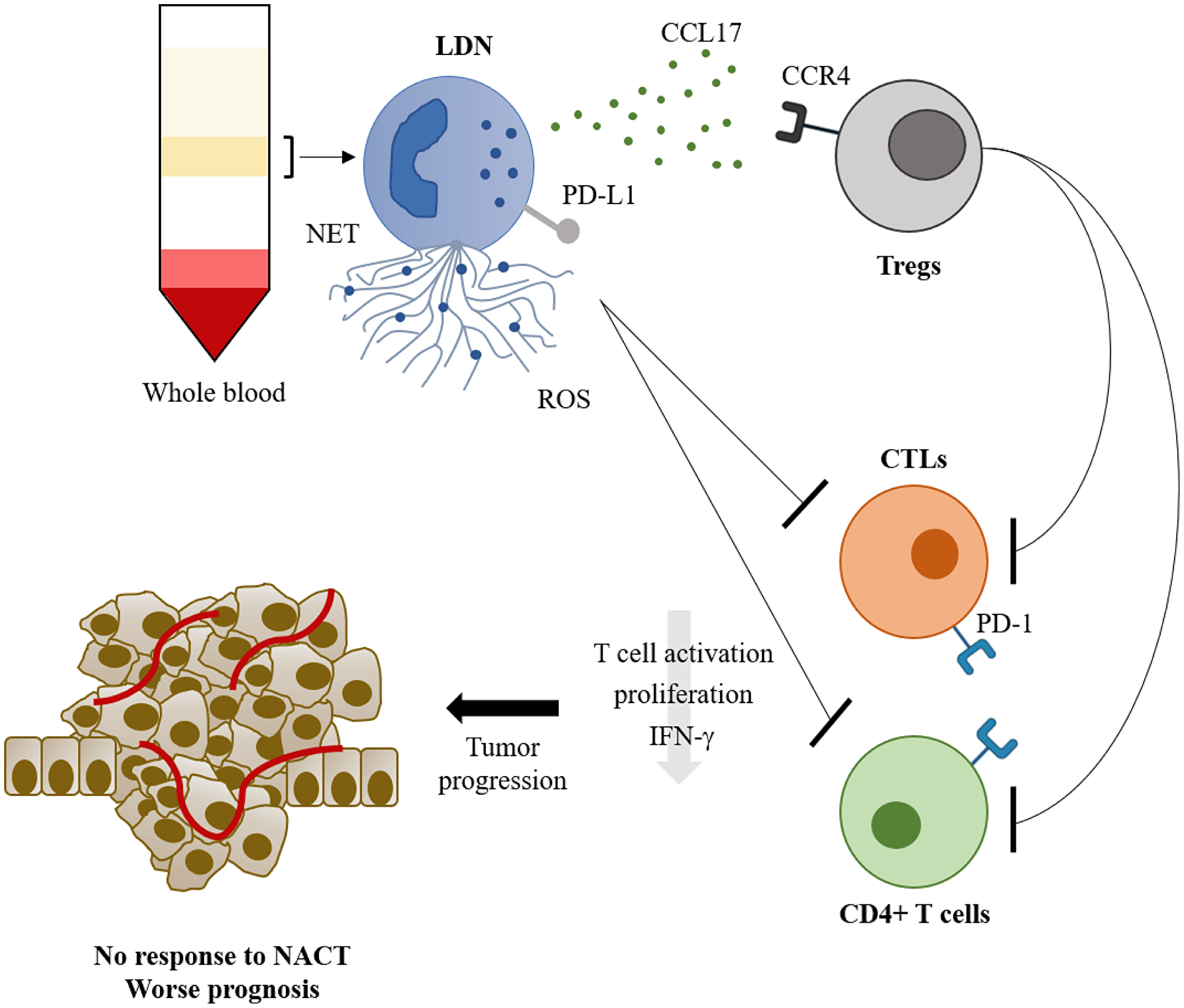 The role of low density neutrophils in breast cancer prognosis and response to neoadjuvant chemotherapy