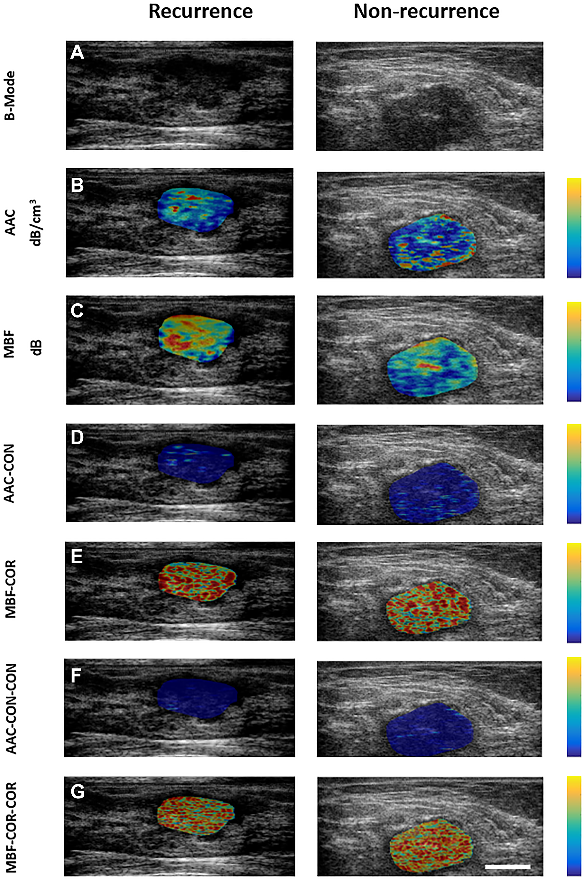(A) Pre-treatment B-Mode images, QUS parametric maps ((B) AAC, (C) MBF), QUS-texture maps ((D) AAC-CON, (E) MBF-COR), and QUS-texture derivative maps ((F) AAC-CON-CON, (G) MBF-CR-COR) for one patient with recurrent disease (left panel) and one without recurrence (right panel). The colour-coded maps are generated over the region corresponding to the tumour using normalized values for individual features within the sub-ROIs. The colour scale on the right side represents the values for the individual features (B) 7 to 64 dB/cm3, (C) −21 to 21 dB, (D) 0 to 34, (E) −0.43 to 0.94, (F) 0 to 53, and (G) −0.54 to 0.94. The scale bar represents 2 cm.
