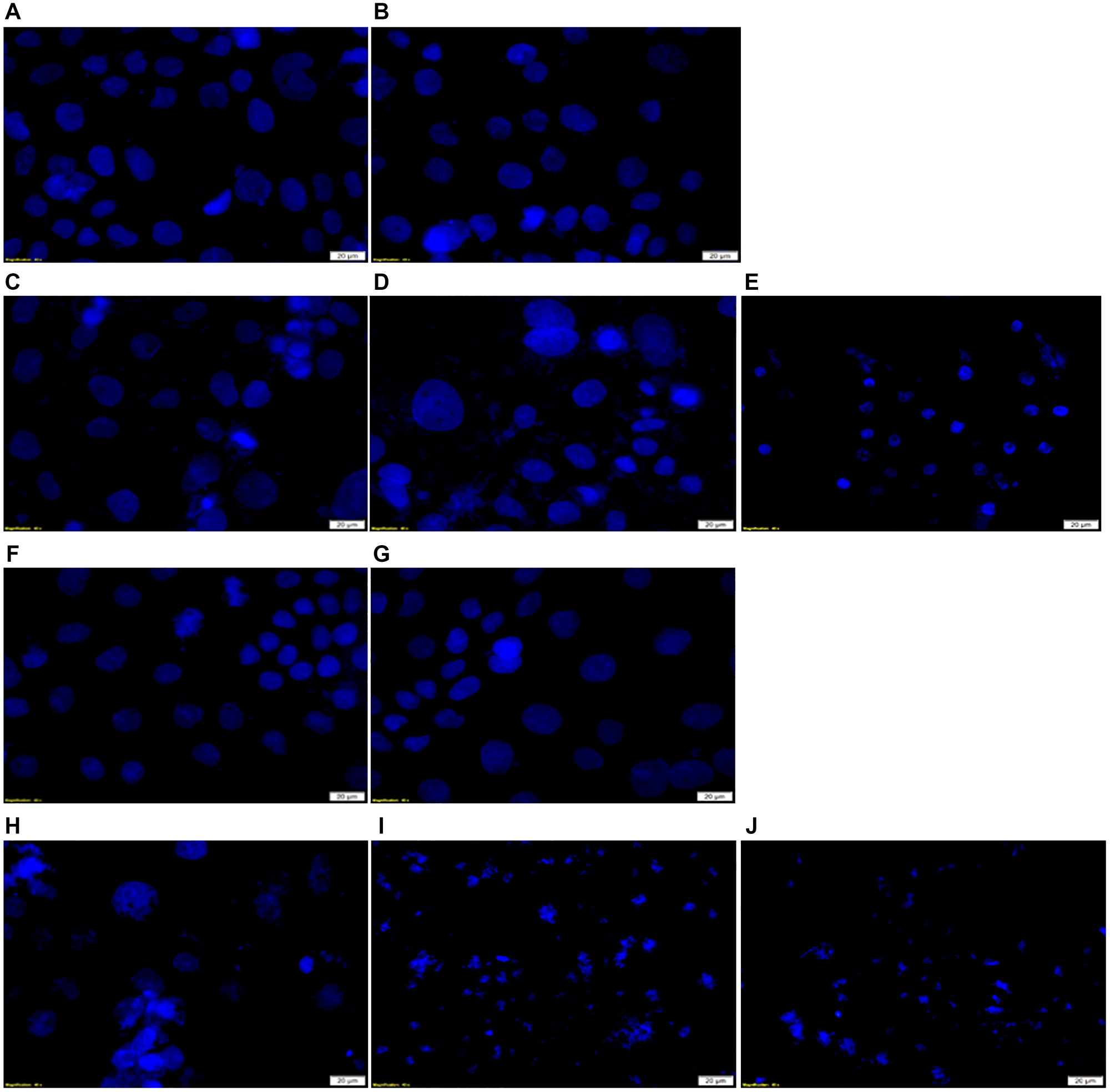 DNA damage Hoechst 33258 stained in vitro CRC cells examination in FNBC PDT response assays with and without CBD treatment