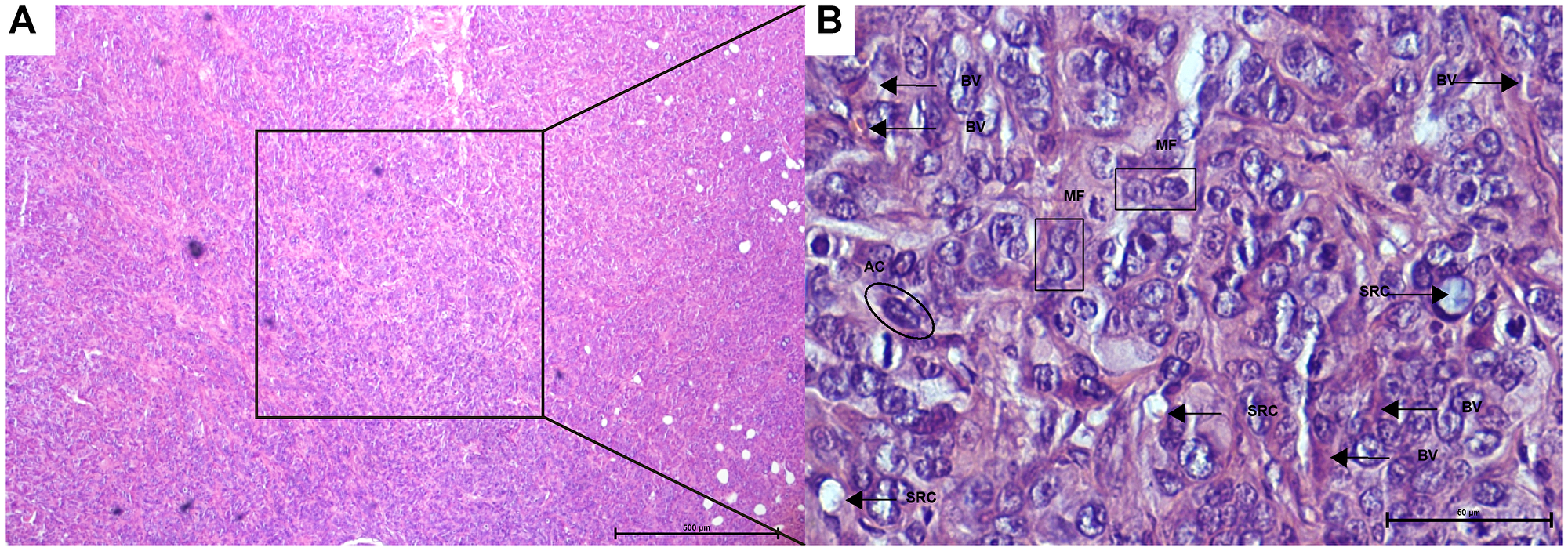 Photomicrographs of colon cancer histopathological features (A, B) following xenogeneic HT-29/CC cells seeding. (A) Global vision. Note the low differentiated adenocarcinoma (less than 25% of glandular formation). (B) Amplification of the square from image A. Note the mitotic figures (MF), including atypical and signet ring cells (SRC), fibrotic beams separating the “nests” of tumor cells, pleomorphic cells with acidophilic cytoplasm (AC), and the vessel structure in the connective tissue (BV). [HE A, 40×; HE B, 400×].