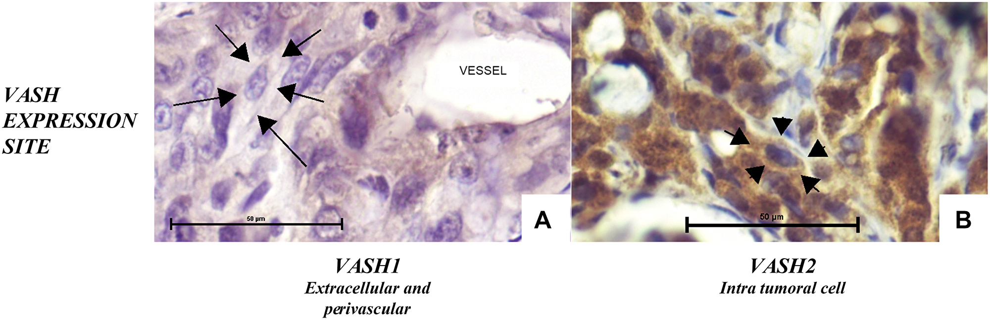 VASH1 (A) and VASH2 (B) expression in untreated CC. VASH1 was found in the extracellular matrix and endothelial cells, whereas VASH2 was found in the intracellular space. [Anti-VASH1 and anti-VASH2, 400×].