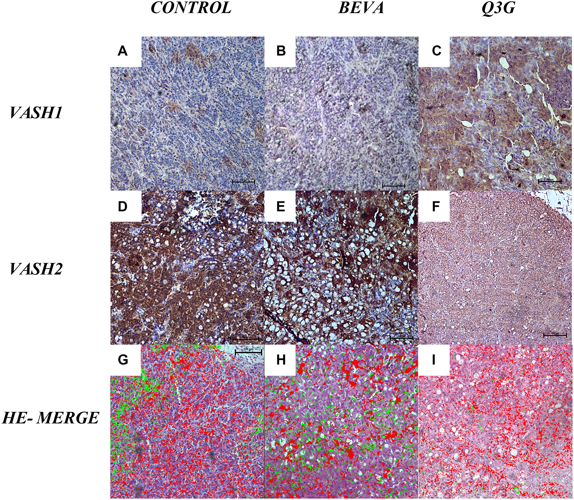 Tissue expression of VASHs (A–F) and VASHs-HE merged (G–I) in untreated (A, D, G), beva-treated (B, E, H), or Q3G-treated CC (C, F, I). VASH1 shows higher expression (C) and VASH2 lower expression (F) in Q3G-treated CC compared to the control [Anti-VASH1 and anti-VASH2, 100x]. HE-Merged (G, H, I) images show VASH1 (red- in the front proliferation zone) and VASH2 (green- in the termination zone) tissue expression in distinct sites in CC. VASH1 was detected in the perivascular matrix, and VASH-2 was intracellular. [HE, 40×].