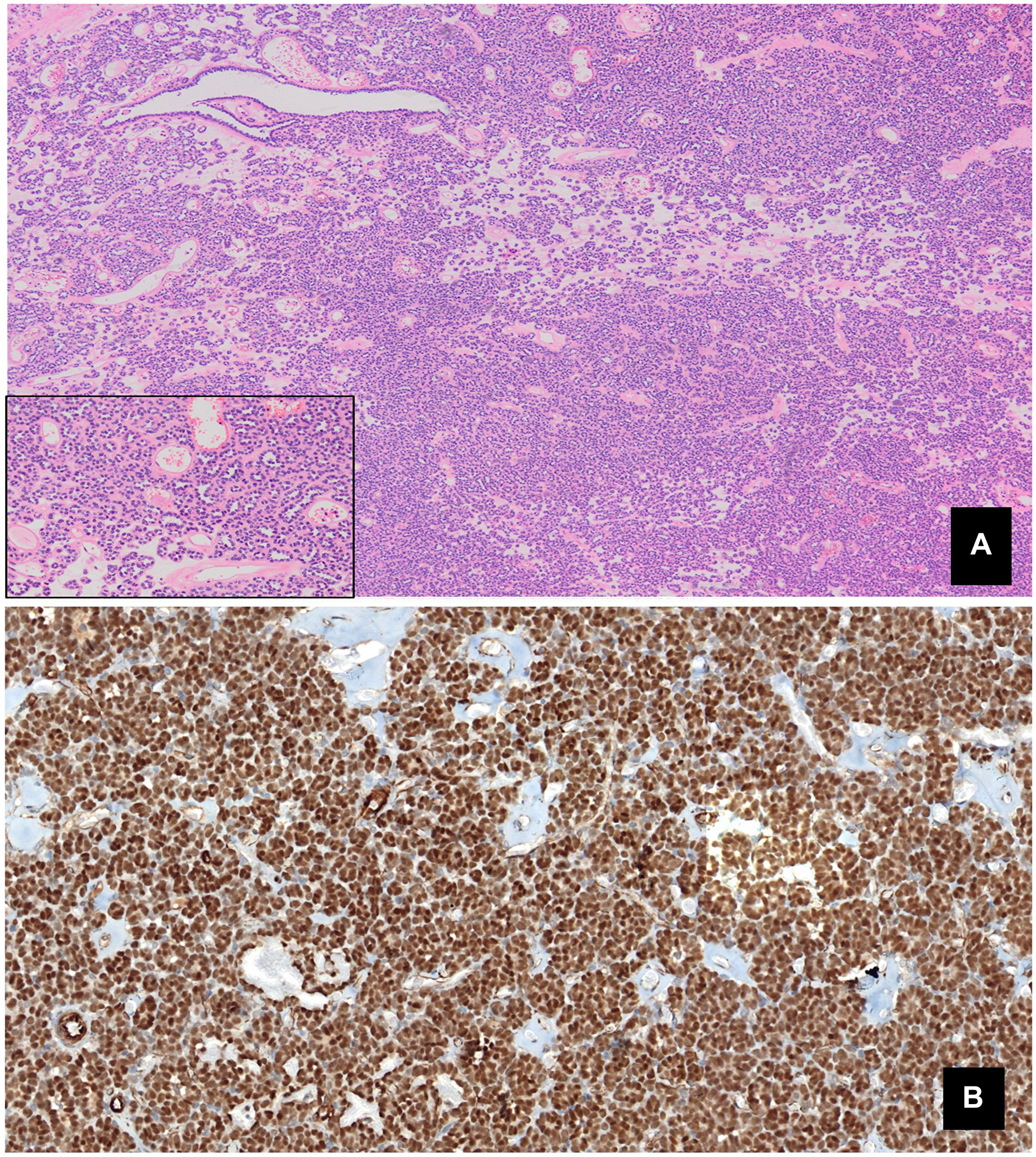 (A) Monomorphic epithelial proliferation, displaying no significant atypia or mitotic figures, within an edematous stroma containing psammoma bodies (Panoramic view. HE). (B) Intense positive nuclear staining for WT1.