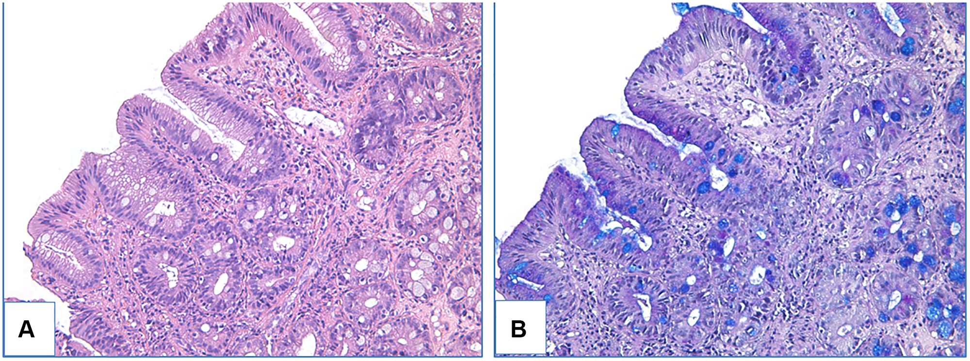 Adenomatous low-grade dysplasia in patient with BE