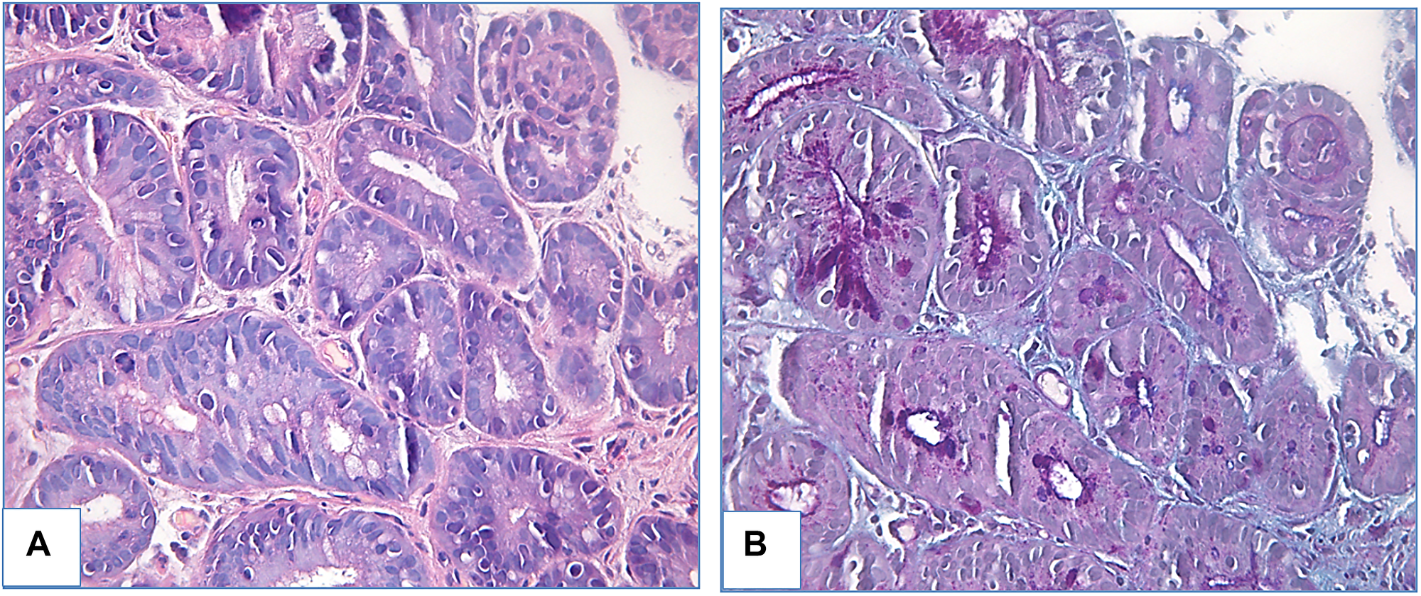 Foveolar low-grade dysplasia in patient with BE