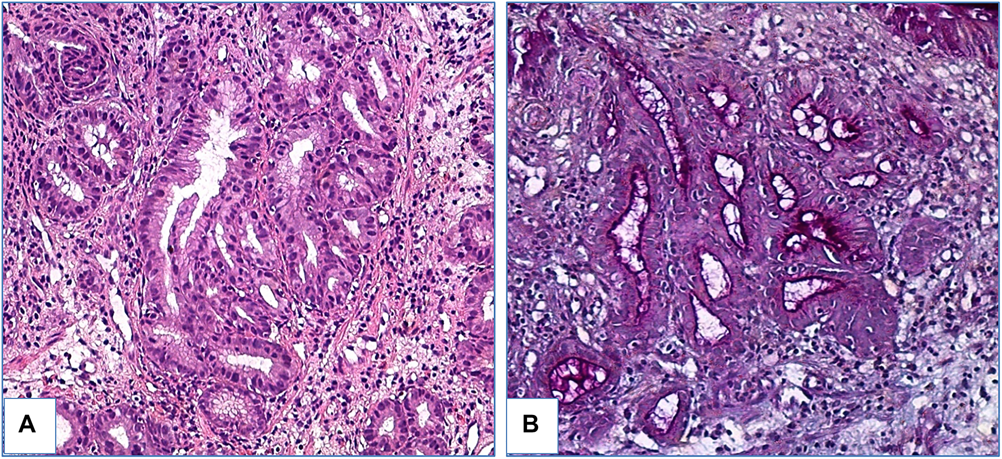 Foveolar high-grade dysplasia in patient with gastric metaplasia