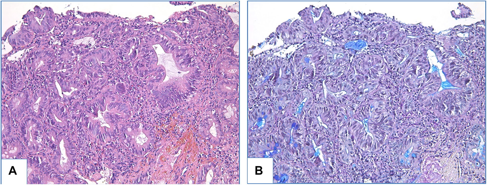 Adenomatous high-grade dysplasia in patient with BE