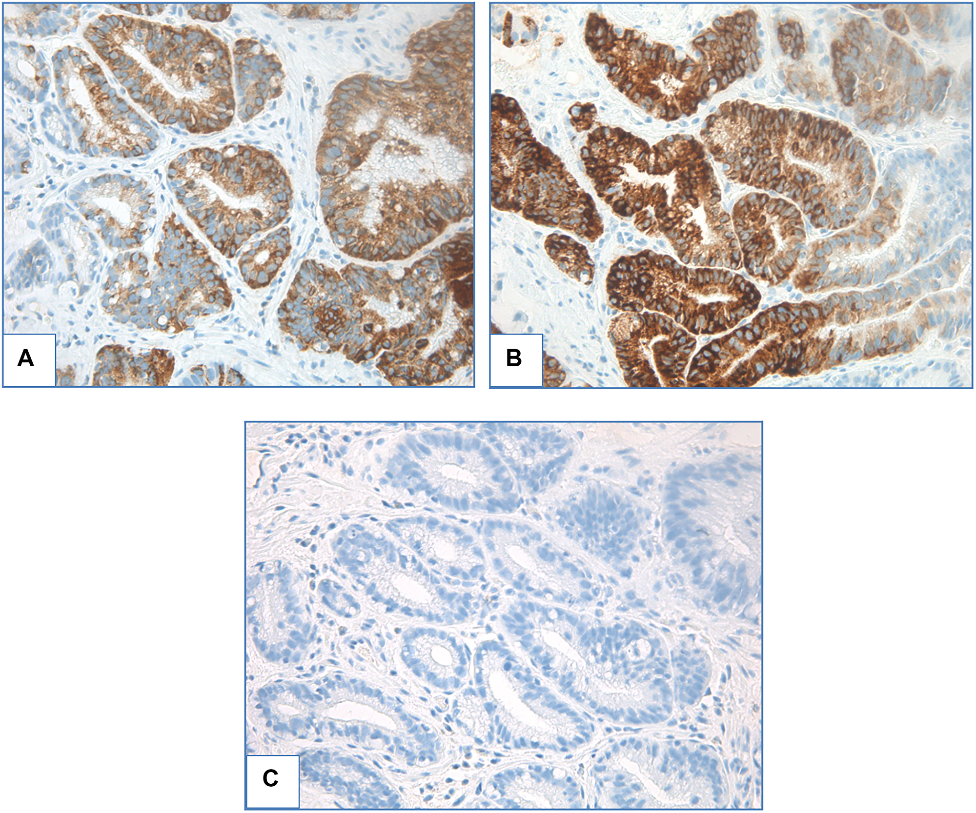 Foveolar low-grade dysplasia
