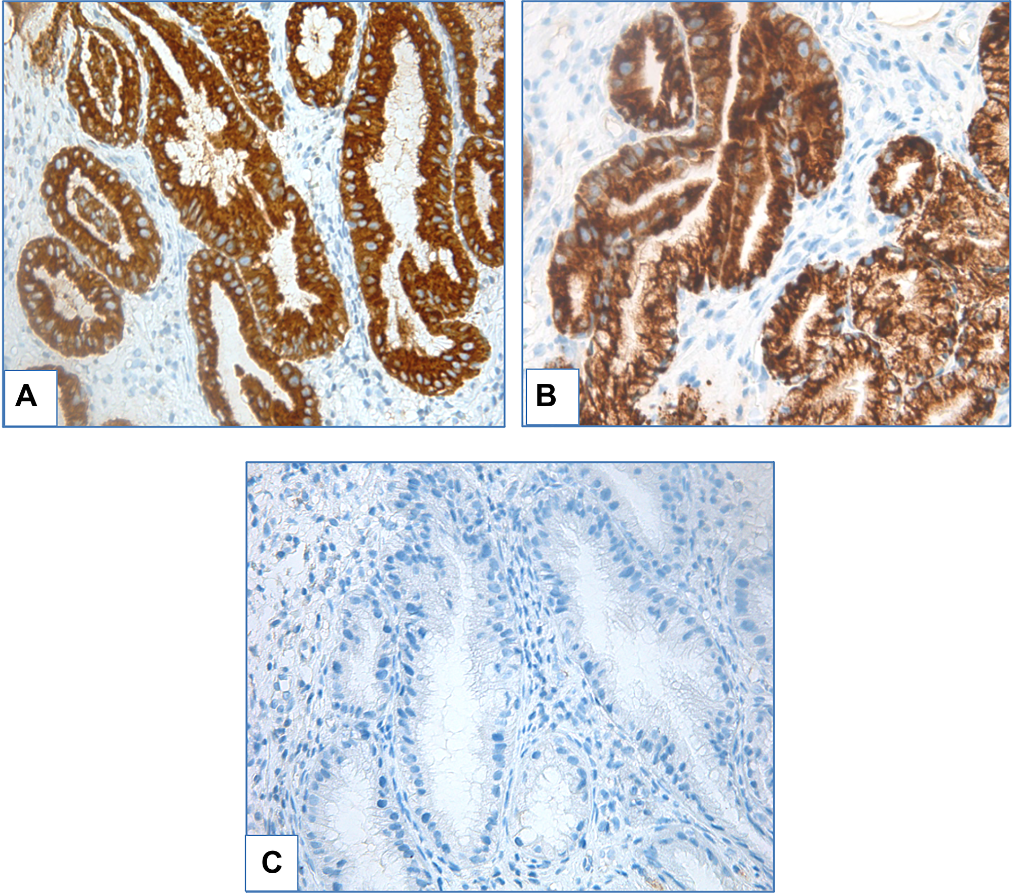 Foveolar high-grade dysplasia