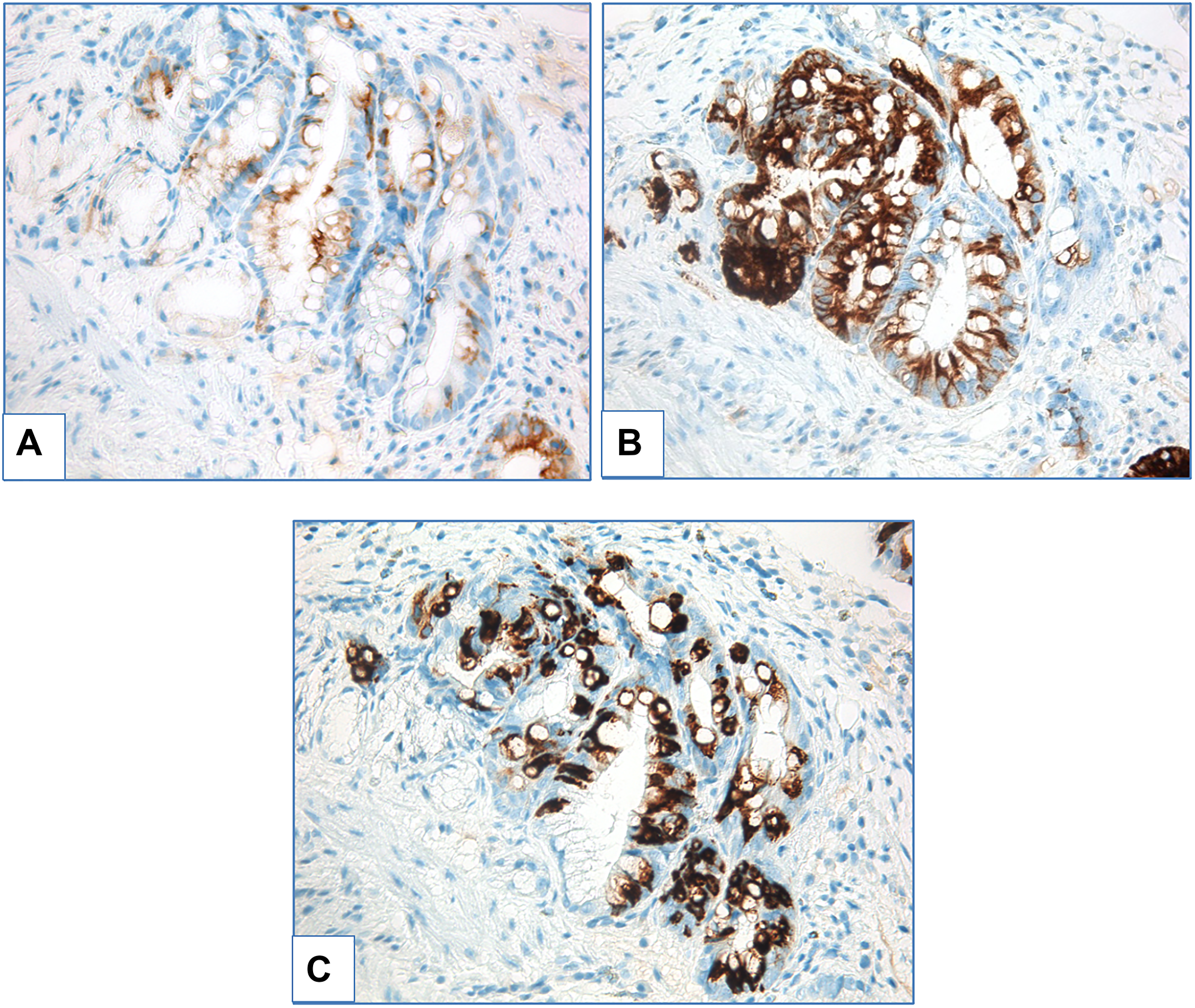 Adenomatous low-grade dysplasia