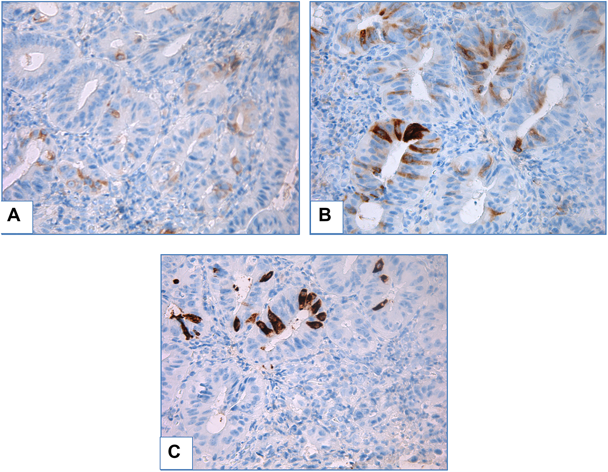 Adenomatous high-grade dysplasia in patient with BE