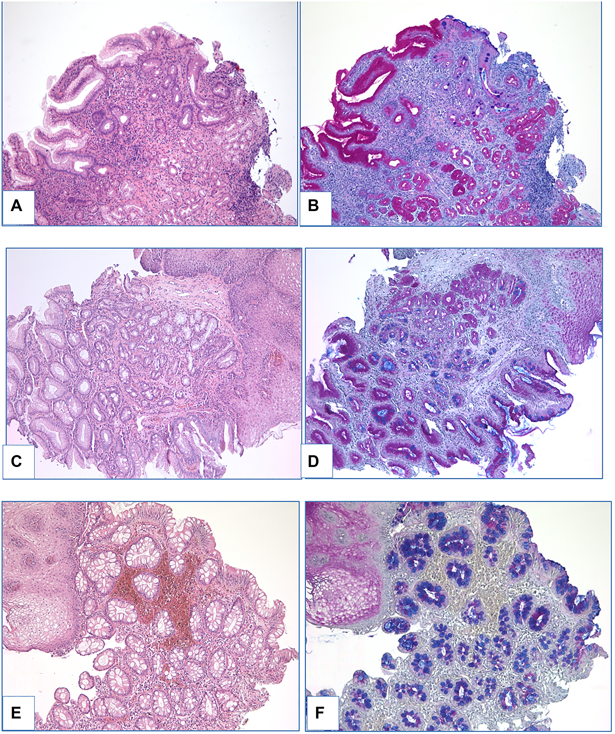 Different density of GC (A–B: few GC; C–D: low density of GC; E–F: high density of GC). (A, C, E) – heamatoxylin and eosin staining, (B, D, F) – PAS-reaction with alcian blue staining, magnification ×100.