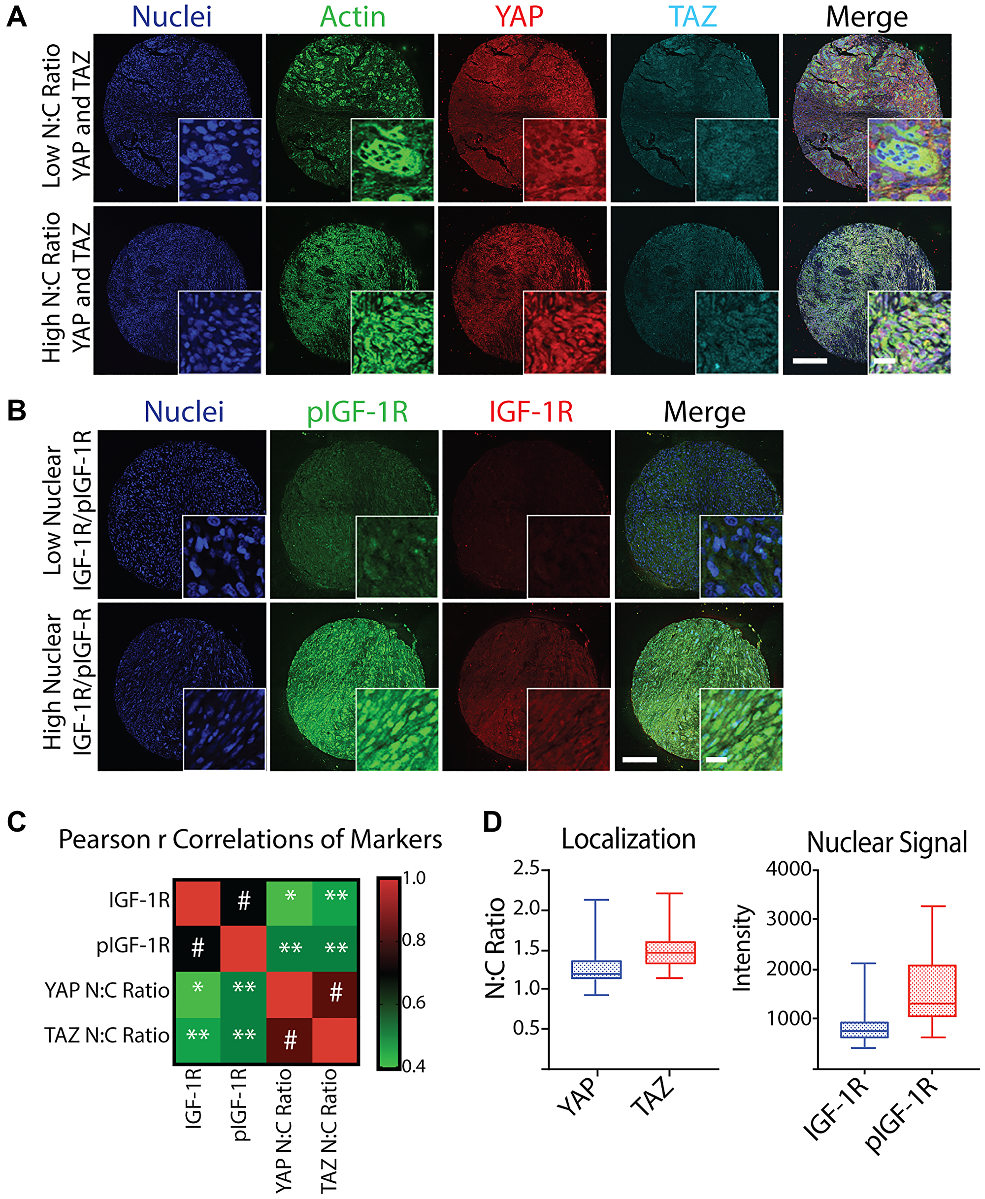 Quantification and correlation of YAP N:C ratio, TAZ N:C ratio, nuclear IGF-1R intensity, and nuclear pIGF-1R intensity from a TMA of post-treatment osteosarcoma biopsies