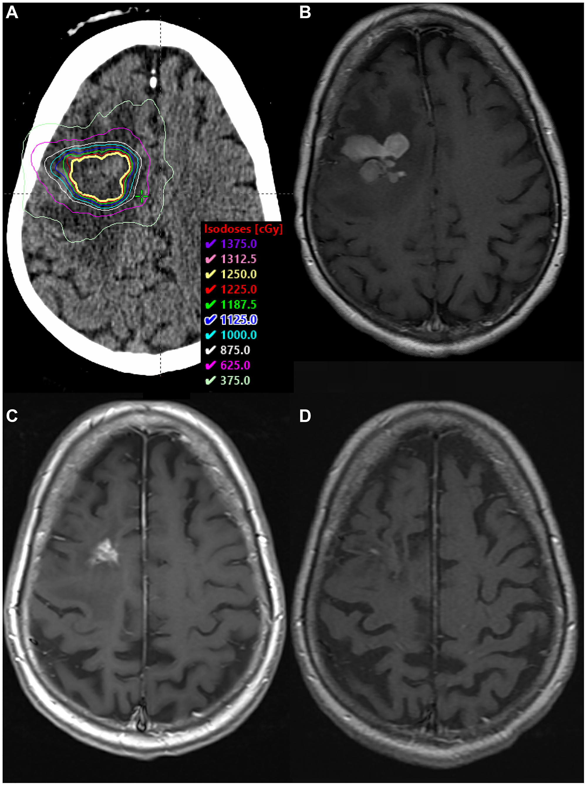 SRS boost treatment plan and MRI scans