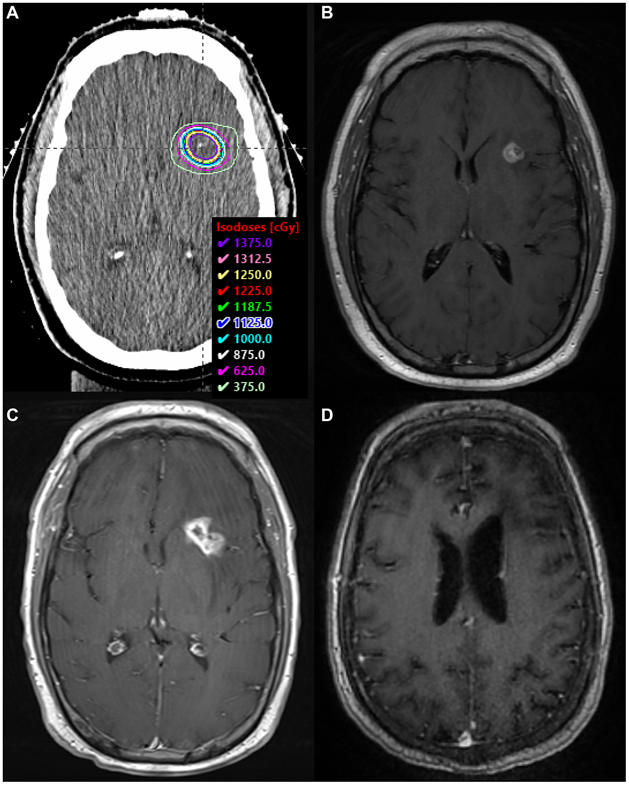 SRS boost treatment plan and MRI scans