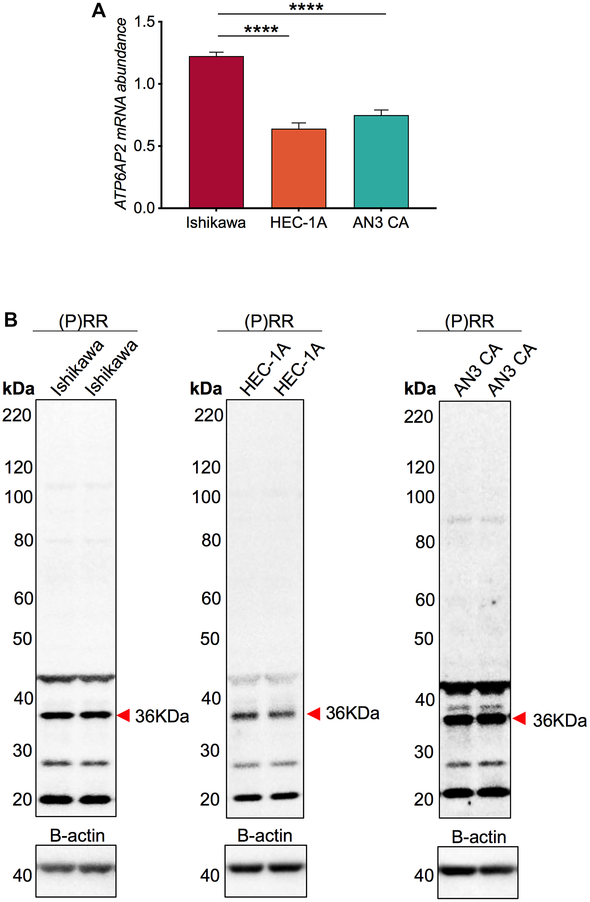 ATP6AP2 mRNA and protein levels in the endometrial epithelial cancer cell lines Ishikawa, AN3CA and HEC-1-A