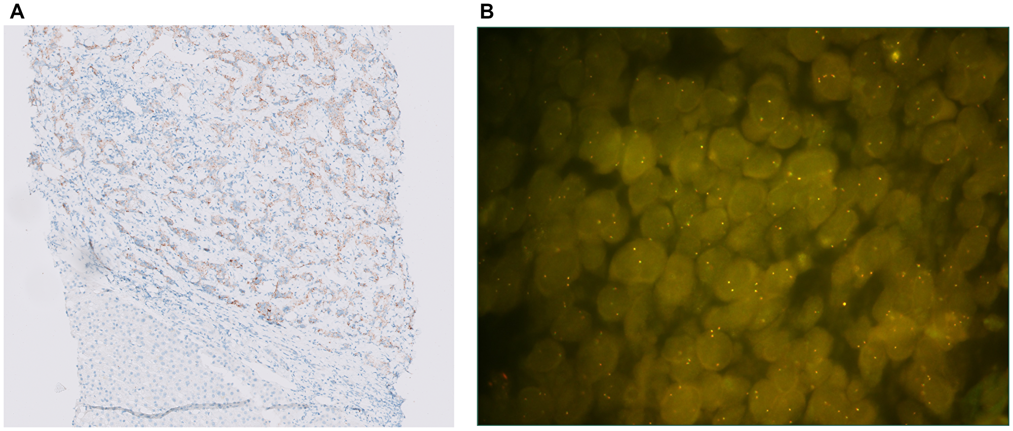 (A) ALK IHC staining (10X): moderate to strong staining in 70% of the tumor cells. (B) ALK FISH: ALK IHC positive SCLC sample without ALK rearrangement (only fused signals present).
