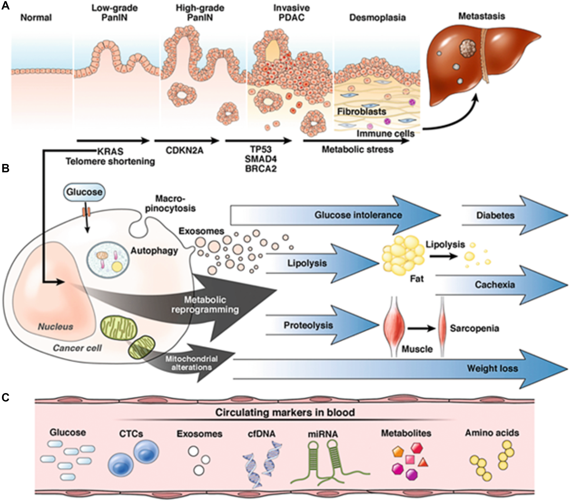 Progression of pancreatic adenocarcinoma (PDAC)