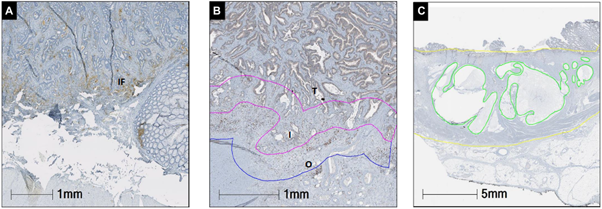 Representative images of PD-L1 (A), CD8 (B) and mucin (C) and staining. The percentage of PD-L1 membranous expression was manually counted in tumor cells tumor stroma and invasive front. The prevalence of CD8+ TILs was recorded in tumor, interface tumor side (inner), interface background rectal side (outer). Mucin expression (green) was determined as percentage of the mucin area in the whole tumor area mass (yellow). Abbreviations: I: inner; IF: invasive front; O: outer front; T: tumor.