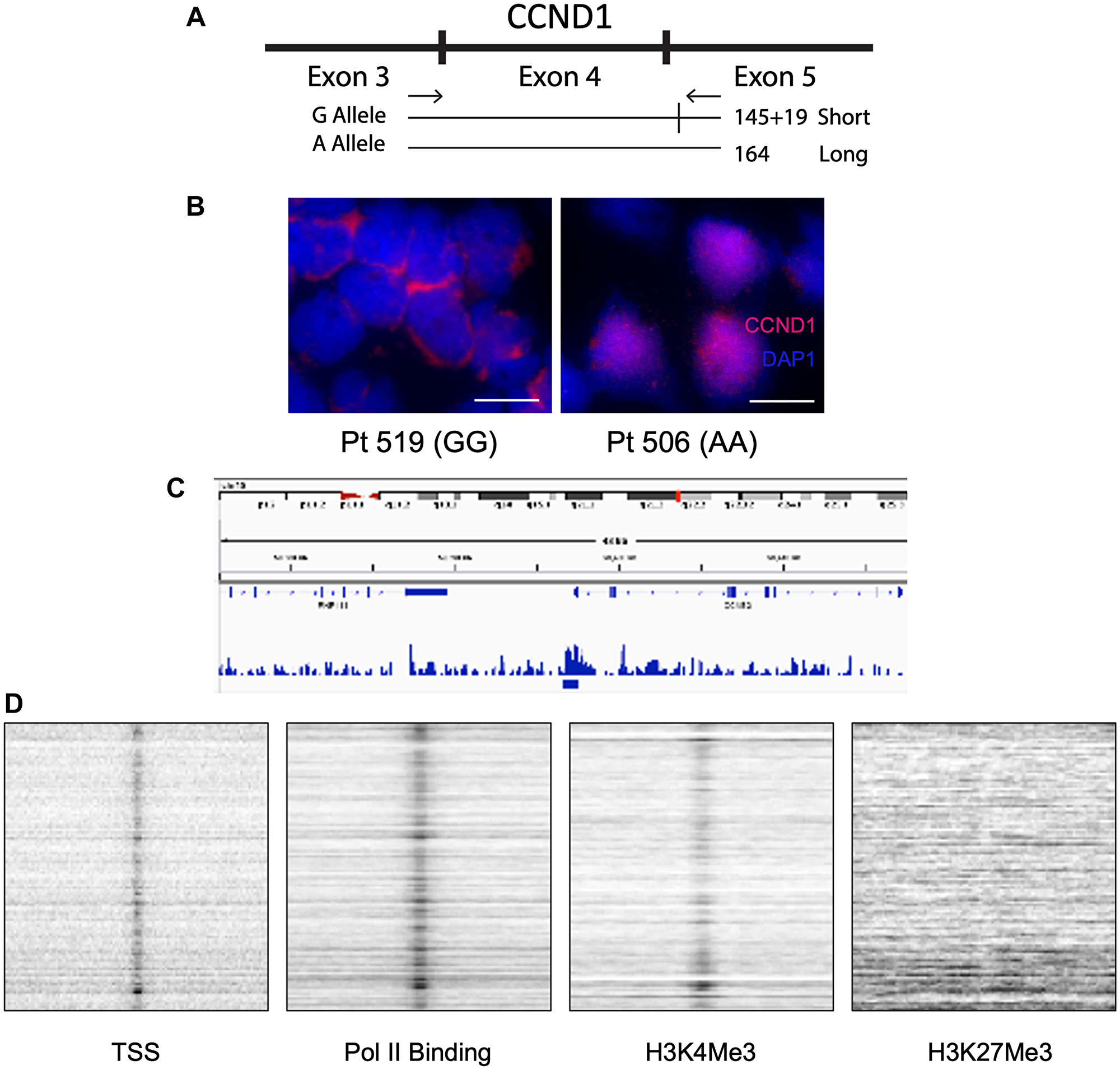 The G/A870 CCND1 polymorphism correlates with cyclin D1 cellular localization and differentiates blastic vs. non-blastic MCL