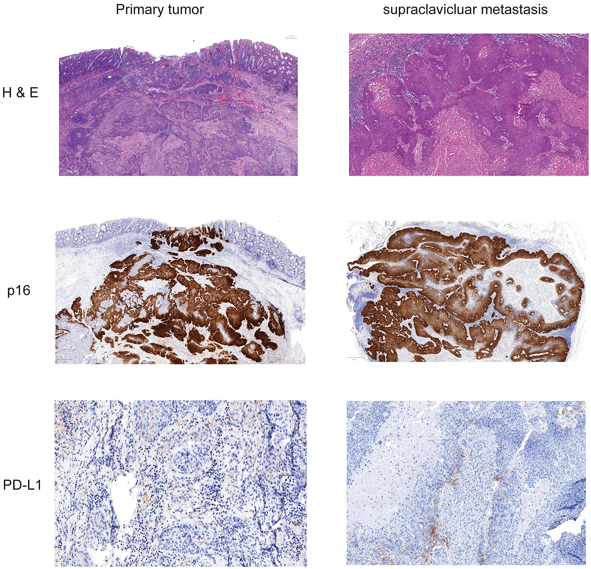 Histochemistry and immunohistochemistry of tumor tissue of primary cancer and lymph node metastasis